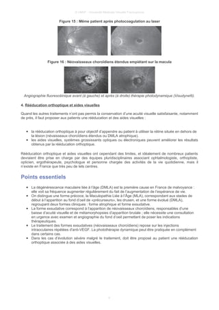 © UMVF - Université Médicale Virtuelle Francophone
Figure 15 : Même patient après photocoagulation au laser
Figure 16 : Néovaisseaux choroïdiens étendus empiétant sur la macula
Angiographie fluorescéinique avant (à gauche) et après (à droite) thérapie photodynamique (Visudyne®).
4. Rééducation orthoptique et aides visuelles
Quand les autres traitements n’ont pas permis la conservation d’une acuité visuelle satisfaisante, notamment
de près, il faut proposer aux patients une rééducation et des aides visuelles :
● la rééducation orthoptique à pour objectif d’appendre au patient à utiliser la rétine située en dehors de
la lésion (névaisseaux choroïdiens étendus ou DMLA atrophique).
● les aides visuelles, systèmes grossissants optiques ou électroniques peuvent améliorer les résultats
obtenus par la rééducation orthoptique.
Rééducation orthoptique et aides visuelles ont cependant des limites, et idéalement de nombreux patients
devraient être prise en charge par des équipes pluridisciplinaires associant ophtalmologiste, orthoptiste,
opticien, ergothérapeute, psychologue et personne chargée des activités de la vie quotidienne, mais il
n’existe en France que très peu de tels centres.
Points essentiels
● La dégénérescence maculaire liée à l’âge (DMLA) est la première cause en France de malvoyance :
elle voit sa fréquence augmenter régulièrement du fait de l’augmentation de l’espérance de vie.
● On distingue une forme précoce, la Maculopathie Liée à l’Âge (MLA), correspondant aux stades de
début à l’apparition au fond d’oeil de «précurseurs», les drusen, et une forme évolué (DMLA),
regroupant deux formes cliniques : forme atrophique et forme exsudative.
● La forme exsudative correspond à l’apparition de néovaisseaux choroïdiens, responsables d’une
baisse d’acuité visuelle et de métamorphopsies d’apparition brutale ; elle nécessite une consultation
en urgence avec examen et angiographie du fond d’oeil permettant de poser les indications
thérapeutiques.
● Le traitement des formes exsudatives (néovaisseaux choroïdiens) repose sur les injections
intraoculaires répétées d'anti-VEGF. La photothérapie dynamique peut être pratiquée en complément
dans certains cas.
● Dans les cas d’évolution sévère malgré le traitement, doit être proposé au patient une rééducation
orthoptique associée à des aides visuelles.
9
 