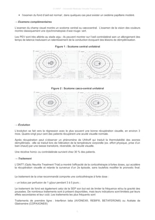 © UMVF - Université Médicale Virtuelle Francophone
● l’examen du fond d’oeil est normal ; dans quelques cas peut exister un oedème papillaire modéré.
→ Examens complémentaires
L’examen du champ visuel montre un scotome central ou cæcocentral. L'examen de la vision des couleurs
montre classiquement une dyschromatopsie d’axe rouge- vert.
Les PEV sont très altérés au stade aigu ; ils peuvent montrer sur l’oeil controlatéral sain un allongement des
temps de latence traduisant un ralentissement de la conduction évoquant des lésions de démyélinisation.
Figure 1 : Scotome central unilatéral
Figure 2 : Scotome cæco-central unilatéral
→ Évolution
L’évolution se fait vers la régression avec le plus souvent une bonne récupération visuelle, en environ 3
mois. Quatre-vingt pour cent des patients récupèrent une acuité visuelle normale.
Après récupération peut s’observer un phénomène de Uhthoff qui traduit la thermolabilité des axones
démyélinisés : elle se traduit lors de l’élévation de la température corporelle (ex. effort physique, prise d’un
bain chaud) par une baisse transitoire, réversible, de l’acuité visuelle.
Une récidive homo- ou controlatérale survient chez 30 % des patients.
→ Traitement
L’ONTT (Optic Neuritis Treatment Trial) a montré l’efficacité de la corticothérapie à fortes doses, qui accélère
la récupération visuelle et retarde la survenue d’un 2e épisode, sans toutefois modifier le pronostic final.
Le traitement de la crise recommandé comporte une corticothérapie à forte dose :
– un bolus par perfusion de 1 g/jour pendant 3 à 5 jours ;
Le traitement de fond est également celui de la SEP son but est de limiter la fréquence et/ou la gravité des
poussées. De nombreux traitements sont à présent disponibles, mais leurs indications sont limitées par leurs
effets secondaires et leur coût. Les traitements les plus fréquents sont
Traitements de première ligne : Interféron béta (AVONEX®, REBIF®, BETAFERON®) ou Acétate de
Glatiramère (COPAXONE®)
4
 