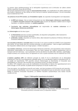 © UMVF - Université Médicale Virtuelle Francophone
Le premier signe ophtalmoscopique de la rétinopathie hypertensive est la diminution de calibre artériel
difficile à apprécier lorsqu’elle est diffuse.
Elle est plus apparente lorsqu’il s’agit de vasoconstriction focale. Les modifications de calibre artériel sont
plus faciles à apprécier sur des clichés du fond d’oeil qu’à l’examen ophtalmoscopique ; ils sont réversibles
avec le traitement de l’HTA.
En présence d’une HTA sévère, ou d’installation rapide, les capacités d’autorégulation sont dépassées :
● la BHR est rompue. Cela se traduit cliniquement par des hémorragies rétiniennes superficielles ,
un oedème maculaire associé à des exsudats secs souvent de disposition stellaire dans la région
maculaire, un oedème maculaire, un oedème papillaire .
● l’occlusion des artérioles précapillaires est responsable de nodules cotonneux et d’
hémorragies rétiniennes profondes .
Les hémorragies sont de deux types :
● en flammèches dans les couches superficielles, de disposition péripapillaire, elles traduisent la
rupture de la barrière hémato rétinienne,
● profondes, rondes, disposées sur toute la rétine, elles traduisent la présence d’infarctus rétiniens par
occlusions artériolaires.
Les exsudats profonds (« exsudats secs ») sont liés à une rupture durable de la BHR et sont d’apparition
plus tardive. Ils sont situés dans les couches profondes, au pôle postérieur ; dans la région périfovéolaire,
leur disposition stellaire donne une image typique « d’étoile maculaire ».
Les nodules cotonneux, comme les hémorragies rétiniennes profondes, sont secondaires à des occlusions
artériolaires responsables de l’accumulation dans les fibres optiques de matériel axoplasmique dont le
transport actif est interrompu ; ils se présentent comme des lésions de petite taille, blanches, superficielles,
d’aspet duveteux et à contours flous. Ils régressent en trois à quatre semaines avec le traitement de l’HTA.
L’oedème papillaire (OP) est l’élément principal du stade III de la classification de la rétinopathie
hypertensive. Il est dû à une hypertension artérielle sévère, ou à une élévation rapide et importante de la TA.
La papille est hyperhémiée, l’OP peut-être entouré d’hémorragies en flammèches et d’exsudats secs
péripapillaires ou associé à des exsudats secs maculaires formant une étoile maculaire.
Au début, l’OP n’entraîne pas ou peu de modifications fonctionnelles en dehors d’un agrandissement de la
tache aveugle. Si l’OP persiste, la papille devient atrophique et l’acuité visuelle chute.
Tous ces signes, non spécifiques lorsqu’ils sont isolés, sont très évocateurs d’HTA lorsqu’ils sont associés ;
ils sont facilement identifiables, mais ne s’accompagnent habituellement pas de diminution d’acuité visuelle.
Malgré la présence d’exsudats maculaires, un oedème maculaire symptomatique avec baisse d’acuité
visuelle est rare.
Figure 1: Rétinopathie hypertensive de stade II
Présence aux deux yeux de nodules cotonneux, d’hémorragies en flammèches, ainsi qu’à l’oeil gauche
d’exsudats profonds («exsudats secs») à disposition stellaire.
4
 