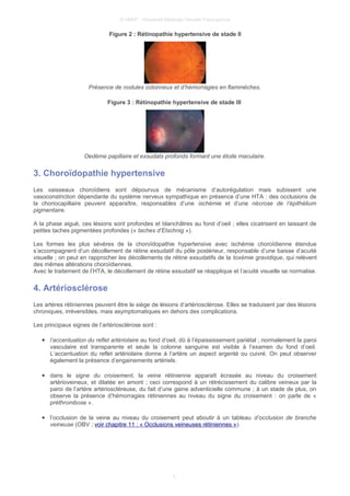 © UMVF - Université Médicale Virtuelle Francophone
Figure 2 : Rétinopathie hypertensive de stade II
Présence de nodules cotonneux et d’hémorragies en flammèches.
Figure 3 : Rétinopathie hypertensive de stade III
Oedème papillaire et exsudats profonds formant une étoile maculaire.
3. Choroïdopathie hypertensive
Les vaisseaux choroïdiens sont dépourvus de mécanisme d’autorégulation mais subissent une
vasoconstriction dépendante du système nerveux sympathique en présence d’une HTA : des occlusions de
la choriocapillaire peuvent apparaître, responsables d’une ischémie et d’une nécrose de l’épithélium
pigmentaire.
A la phase aiguë, ces lésions sont profondes et blanchâtres au fond d’oeil ; elles cicatrisent en laissant de
petites taches pigmentées profondes (« taches d’Elschnig »).
Les formes les plus sévères de la choroïdopathie hypertensive avec ischémie choroïdienne étendue
s’accompagnent d’un décollement de rétine exsudatif du pôle postérieur, responsable d’une baisse d’acuité
visuelle ; on peut en rapprocher les décollements de rétine exsudatifs de la toxémie gravidique, qui relèvent
des mêmes altérations choroïdiennes.
Avec le traitement de l’HTA, le décollement de rétine exsudatif se réapplique et l’acuité visuelle se normalise.
4. Artériosclérose
Les artères rétiniennes peuvent être le siège de lésions d’artériosclérose. Elles se traduisent par des lésions
chroniques, irréversibles, mais asymptomatiques en dehors des complications.
Les principaux signes de l’artériosclérose sont :
● l’accentuation du reflet artériolaire au fond d’oeil, dû à l’épaississement pariétal ; normalement la paroi
vasculaire est transparente et seule la colonne sanguine est visible à l’examen du fond d’oeil.
L’accentuation du reflet artériolaire donne à l’artère un aspect argenté ou cuivré. On peut observer
également la présence d’engainements artériels.
● dans le signe du croisement, la veine rétinienne apparaît écrasée au niveau du croisement
artérioveineux, et dilatée en amont ; ceci correspond à un rétrécissement du calibre veineux par la
paroi de l’artère artérioscléreuse, du fait d’une gaine adventicielle commune ; à un stade de plus, on
observe la présence d’hémorragies rétiniennes au niveau du signe du croisement : on parle de «
préthrombose ».
● l’occlusion de la veine au niveau du croisement peut aboutir à un tableau d’occlusion de branche
veineuse (OBV ; voir chapitre 11 : « Occlusions veineuses rétiniennes »).
5
 