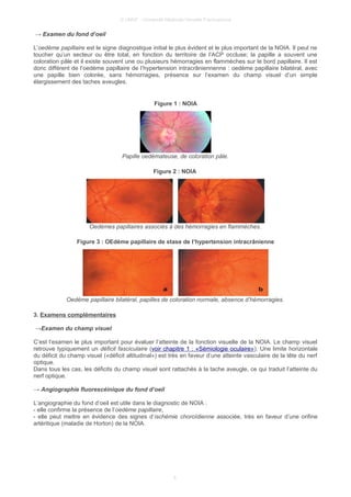 © UMVF - Université Médicale Virtuelle Francophone
→ Examen du fond d’oeil
L’oedème papillaire est le signe diagnostique initial le plus évident et le plus important de la NOIA. Il peut ne
toucher qu’un secteur ou être total, en fonction du territoire de l’ACP occluse; la papille a souvent une
coloration pâle et il existe souvent une ou plusieurs hémorragies en flammèches sur le bord papillaire. Il est
donc différent de l’oedème papillaire de l’hypertension intracrâniennenne : oedème papillaire bilatéral, avec
une papille bien colorée, sans hémorragies, présence sur l’examen du champ visuel d’un simple
élargissement des taches aveugles.
Figure 1 : NOIA
Papille oedémateuse, de coloration pâle.
Figure 2 : NOIA
Oedèmes papillaires associés à des hémorragies en flammèches.
Figure 3 : OEdème papillaire de stase de l’hypertension intracrânienne
Oedème papillaire bilatéral, papilles de coloration normale, absence d’hémorragies.
3. Examens complémentaires
→Examen du champ visuel
C’est l’examen le plus important pour évaluer l’atteinte de la fonction visuelle de la NOIA. Le champ visuel
retrouve typiquement un déficit fasciculaire (voir chapitre 1 : «Sémiologie oculaire»). Une limite horizontale
du déficit du champ visuel («déficit altitudinal») est très en faveur d’une atteinte vasculaire de la tête du nerf
optique.
Dans tous les cas, les déficits du champ visuel sont rattachés à la tache aveugle, ce qui traduit l’atteinte du
nerf optique.
→ Angiographie fluorescéinique du fond d’oeil
L’angiographie du fond d’oeil est utile dans le diagnostic de NOIA :
- elle confirme la présence de l’oedème papillaire,
- elle peut mettre en évidence des signes d’ischémie choroïdienne associée, très en faveur d’une orifine
artéritique (maladie de Horton) de la NOIA.
4
 