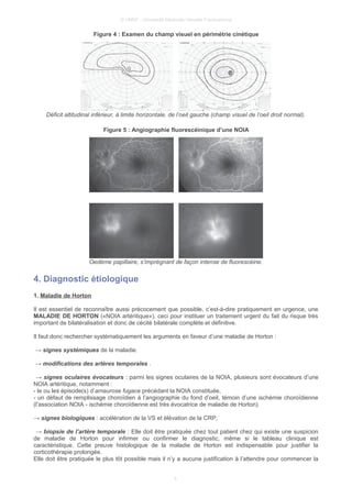 © UMVF - Université Médicale Virtuelle Francophone
Figure 4 : Examen du champ visuel en périmétrie cinétique
Déficit altitudinal inférieur, à limite horizontale, de l’oeil gauche (champ visuel de l’oeil droit normal).
Figure 5 : Angiographie fluorescéinique d’une NOIA
Oedème papillaire, s’imprégnant de façon intense de fluorescéine.
4. Diagnostic étiologique
1. Maladie de Horton
Il est essentiel de reconnaître aussi précocement que possible, c’est-à-dire pratiquement en urgence, une
MALADIE DE HORTON («NOIA artéritique»), ceci pour instituer un traitement urgent du fait du risque très
important de bilatéralisation et donc de cécité bilatérale complète et définitive.
Il faut donc rechercher systématiquement les arguments en faveur d’une maladie de Horton :
→ signes systémiques de la maladie.
→ modifications des artères temporales .
→ signes oculaires évocateurs : parmi les signes oculaires de la NOIA, plusieurs sont évocateurs d’une
NOIA artéritique, notamment :
- le ou les épisode(s) d’amaurose fugace précédant la NOIA constituée,
- un défaut de remplissage choroïdien à l’angiographie du fond d’oeil, témoin d’une ischémie choroïdienne
(l’association NOIA - ischémie choroïdienne est très évocatrice de maladie de Horton).
→ signes biologiques : accélération de la VS et élévation de la CRP,
→ biopsie de l’artère temporale : Elle doit être pratiquée chez tout patient chez qui existe une suspicion
de maladie de Horton pour infirmer ou confirmer le diagnostic, même si le tableau clinique est
caractéristique. Cette preuve histologique de la maladie de Horton est indispensable pour justifier la
corticothérapie prolongée.
Elle doit être pratiquée le plus tôt possible mais il n’y a aucune justification à l’attendre pour commencer la
5
 
