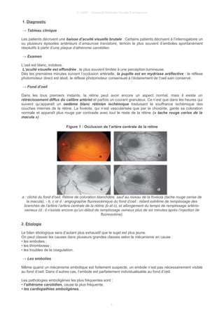 © UMVF - Université Médicale Virtuelle Francophone
1. Diagnostic
→ Tableau clinique
Les patients décrivent une baisse d’acuité visuelle brutale . Certains patients décrivent à l’interrogatoire un
ou plusieurs épisodes antérieurs d’amaurose tranistoire, témoin le plus souvent d’emboles spontanément
résolutifs à partir d’une plaque d’athérome carotidien.
→ Examen
L’oeil est blanc, indolore.
L’acuité visuelle est effondrée , le plus souvent limitée à une perception lumineuse.
Dès les premières minutes suivant l’occlusion artérielle, la pupille est en mydriase aréflective : le réflexe
photomoteur direct est aboli, le réflexe photomoteur consensuel à l’éclairement de l’oeil sain conservé.
→ Fond d’oeil
Dans les tous premiers instants, la rétine peut avoir encore un aspect normal, mais il existe un
rétrécissement diffus du calibre artériel et parfois un courant granuleux. Ce n’est que dans les heures qui
suivent qu’apparaît un oedème blanc rétinien ischémique traduisant la souffrance ischémique des
couches internes de la rétine. La fovéola, qui n’est vascularisée que par la choroïde, garde sa coloration
normale et apparaît plus rouge par contraste avec tout le reste de la rétine (« tache rouge cerise de la
macula ») .
Figure 1 : Occlusion de l’artère centrale de la rétine
a : cliché du fond d’oeil. Rétine de coloration blanchâtre, sauf au niveau de la fovéola (tache rouge cerise de
la macula), - b, c et d : angiographie fluorescéinique du fond d’oeil : retard extrême de remplissage des
branches de l’artère l’artère centrale de la rétine (b et c), et allongement du temps de remplissage artério-
veineux (d : il n’existe encore qu’un début de remplissage veineux plus de six minutes après l’injection de
fluorescéine).
2. Étiologie
Le bilan étiologique sera d’autant plus exhaustif que le sujet est plus jeune.
On peut classer les causes dans plusieurs grandes classes selon le mécanisme en cause :
• les embolies ;
• les thromboses ;
• les troubles de la coagulation.
→ Les embolies
Même quand un mécanisme embolique est fortement suspecté, un embole n’est pas nécessairement visible
au fond d’oeil. Dans d’autres cas, l’embole est parfaitement individualisable au fond d’oeil.
Les pathologies emboligènes les plus fréquentes sont :
• l’athérome carotidien, cause la plus fréquente,
• les cardiopathies emboligènes.
4
 