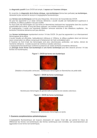 © UMVF - Université Médicale Virtuelle Francophone
Le diagnostic positif d’une OVCR est simple, il repose sur l’examen clinique .
En revanche, le diagnostic de la forme clinique, non-ischémique (forme bien perfusée) ou ischémique ,
nécessite le plus souvent le recours à l’angiographie fluorescéinique.
Les formes non-ischémiques sont les plus fréquentes, 3/4 environ de l’ensemble des OVCR.
On peut les apparenter à un stase veineuse rétinienne. L’acuité visuelle est habituellement supérieure à
2/10èmes, le réflexe pupillaire n’est pas modifié.
Au fond d’oeil, les hémorragies ont une forme en flammèches traduisant leur topographie dans les couches
superficielles de la rétine, le long des fibres optiques. Les nodules cotonneux sont rares.
En angiographie, il existe une importante dilatation veineuse associée à des dilatations capillaires ; les
territoires d’ischémie rétinienne sont peu étendus.
Les formes ischémiques représentent environ 1/4 des OVCR. On peut les apparenter à un infarcissement
hémorragique de la rétine.
L’acuité visuelle est effondrée, habituellement inférieure à 1/20ème, le réflexe pupillaire direct est diminué
(avec conservation du réflexe consensuel à l’éclairement de l’oeil controlatéral sain).
À l’examen du fond d’oeil, les hémorragies sont plus volumineuses, profondes, «en tache», témoin de
l’ischémie rétinienne ; il existe souvent de nombreux nodules cotonneux.
L’angiographie fluorescéinique confirme la présence de vastes territoires d’ischémie rétinienne.
Le passage d’une forme non-ischémique à une forme ischémique peut être observé (environ 1/4 des
formes non-ischémiques).
Figure 1 : OVCR de forme non-ischémique
Dilatation et tortuosités veineuses ; nombreuses hémorragies en flammèches de petite taille.
Figure 2 : OVCR de forme ischémique
Nombreuses hémorragies de grande taille et présence de nodules cotonneux.
Figure 3 : OVCR de forme ischémique
Présence de nombreuses hémorragies en tache.
3. Examens complémentaires ophtalmologiques
L’angiographie fluorescéinique est toujours nécessaire (cf. supra). C’est elle qui permet le mieux de
différencier les formes non-ischémiques des formes ischémiques (soit d’emblée, soit secondairement par
aggravation d’une forme non-ischémique).
4
 