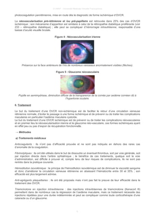 © UMVF - Université Médicale Virtuelle Francophone
photocoagulation panrétinienne, mise en route dès le diagnostic de forme ischémique d’OVCR.
La néovascularisation pré-rétinienne et /ou pré-papillaire est retrouvée dans 25% des cas d’OVCR
ischémique ; son mécanisme d’apparition est similaire à celui de la rétinopathie diabétique proliférante (voir
233 – rétinopathie diabétique) ; elle peut se compliquer d’hémorragie intravitréenne, responsable d’une
baisse d’acuité visuelle brutale.
Figure 4 : Néovascularisation irienne
Présence sur la face antérieure de l’iris de nombreux vaisseaux anormalement visibles (flèches).
Figure 5 : Glaucome néovasculaire
Pupille en semimydriase, diminution diffuse de la transparence de la cornée par oedème cornéen dû à
l’hypertonie oculaire.
6. Traitement
Le but du traitement d’une OVCR non-ischémique est de faciliter le retour d’une circulation veineuse
rétinienne normale, d’éviter le passage à une forme ischémique et de prévenir ou de traiter les complications
maculaires en particulier l’oedème maculaire cystoïde.
Le but du traitement d’une OVCR ischémique est de prévenir ou de traiter les complications néovasculaires
et en premier lieu la néovascularisation irienne et le glaucome néo-vasculaire, ces formes ischémiques ayant
en effet peu ou pas d’espoir de récupération fonctionnelle.
→ Méthodes
a) Traitements médicaux
Anticoagulants : ils n’ont pas d’efficacité prouvée et ne sont pas indiqués en dehors des rares cas
d’anomalie de la coagulation.
Fibrinolytiques : ils ont été utilisés dans le but de dissoudre un éventuel thrombus, soit par voie générale, soit
par injection directe dans l’artère ophtalmique ; le bénéfice de ces traitements, quelque soit la voie
d’administration, est difficile à prouver et, compte tenu de leur risques de complications, ils ne sont pas
rentrés dans la pratique courante.
Hémodilution isovolémique : le principe de l’hémodilution isovolémique est de diminuer la viscosité sanguine
et donc d’améliorer la circulation veineuse rétinienne en abaissant l’hématocrite entre 30 et 35% ; son
efficacité est plus largement admise.
Anti-agrégants plaquettaires : ils ont été proposés mais n’ont pas fait la preuve de leur efficacité dans le
traitement des OVCR.
Triamcinolone en injection intravitréenne : des injections intravitréennes de triamcinolone (Kenacort ®)
permettent dans de nombreux cas la régression de l’oedème maculaire, mais ce traitement nécessite des
injections répétées pour une durée indéterminée et peut se compliquer comme toute corticothérapie d’une
cataracte ou d’un glaucome.
6
 
