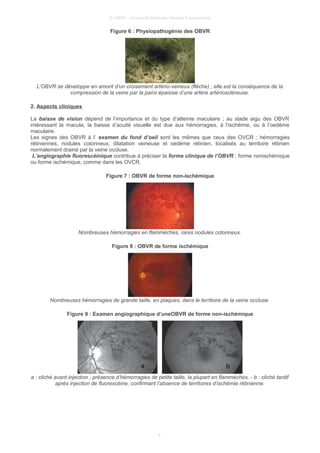 © UMVF - Université Médicale Virtuelle Francophone
Figure 6 : Physiopathogénie des OBVR
L’OBVR se développe en amont d’un croisement artério-veineux (flèche) ; elle est la conséquence de la
compression de la veine par la paroi épaissie d’une artère artérioscléreuse.
2. Aspects cliniques
La baisse de vision dépend de l’importance et du type d’atteinte maculaire ; au stade aigu des OBVR
intéressant la macula, la baisse d’acuité visuelle est due aux hémorragies, à l’ischémie, ou à l’oedème
maculaire.
Les signes des OBVR à l’ examen du fond d’oeil sont les mêmes que ceux des OVCR : hémorragies
rétiniennes, nodules cotonneux, dilatation veineuse et oedème rétinien, localisés au territoire rétinien
normalement drainé par la veine occluse.
L’angiographie fluorescéinique contribue à préciser la forme clinique de l’OBVR : forme nonischémique
ou forme ischémique, comme dans les OVCR.
Figure 7 : OBVR de forme non-ischémique
Nombreuses hémorragies en flammèches, rares nodules cotonneux.
Figure 8 : OBVR de forme ischémique
Nombreuses hémorragies de grande taille, en plaques, dans le territoire de la veine occluse.
Figure 9 : Examen angiographique d’uneOBVR de forme non-ischémique
a : cliché avant injection ; présence d’hémorragies de petite taille, la plupart en flammèches. - b : cliché tardif
après injection de fluorescéine, confirmant l’absence de territoires d’ischémie rétinienne.
8
 