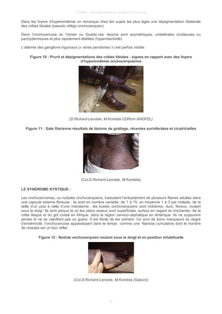 © UMVF - Université Médicale Virtuelle Francophone
Dans les foyers d’hyperendémie on remarque chez les sujets les plus âgés une dépigmentation bilatérale
des crêtes tibiales (pseudo vitiligo onchocerquien).
Dans l’onchocercose du Yémen ou Sowda ces lésions sont asymétriques, unilatérales croûteuses ou
pachydermiques et plus rapidement établies (hyperréactivité).
L’atteinte des ganglions inguinaux (« aines pendantes ») est parfois visible.
Figure 10 : Prurit et dépigmentations des crêtes tibiales : signes en rapport avec des foyers
d’hyperendémie onchocerquienne
(D.Richard-Lenoble, M.Kombila CDRom ANOFEL)
Figure 11 : Gale filarienne résultats de lésions de grattage, récentes surinfectées et cicatricielles
(Col.D.Richard-Lenoble, M.Kombila)
LE SYNDROME KYSTIQUE :
Les onchocercomes, ou nodules onchocerquiens, traduisent l’enkystement de plusieurs filaires adultes dans
une capsule externe fibreuse ; ils sont en nombre variable, de 1 à 15, en moyenne 1 à 3 par malade, de la
taille d’un pois à celle d’une mandarine ; les kystes onchocerquiens sont indolores, durs, fibreux, roulant
sous le doigt. Ils sont perçus là où les plans osseux sont superficiels, surtout en regard du trochanter, de la
crête iliaque et du gril costal en Afrique, dans la région cervico-céphalique en Amérique. Ils ne suppurent
jamais et ne se calcifient pas ou guère. Il est facile de les extraire. Ce sont de bons marqueurs du degré
d’endémicité, l’onchocercose apparaissant dans le temps comme une filariose cumulative dont le nombre
de nodules est un bon reflet.
Figure 12 : Nodule onchocerquien roulant sous le doigt et en position inhabituelle
(Col.D.Richard-Lenoble, M.Kombila (Gabon))
12
 