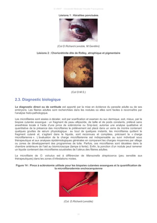 © UMVF - Université Médicale Virtuelle Francophone
Lésions 1 : Kératites ponctuées
(Col D.Richard-Lenoble, M.Gentilini)
Lésions 2 : Choriorétinite dite de Ridley, atrophique et pigmentaire
(Col O.M.S.)
2.3. Diagnostic biologique
Le diagnostic direct ou de certitude est apporté par la mise en évidence du parasite adulte ou de ses
embryons. Les filaires adultes sont recherchées dans les nodules où elles sont faciles à reconnaître par
l’analyse histo-pathologique.
Les microfilaires sont aisées à déceler, soit par scarification et examen du suc dermique, soit, mieux, par la
biopsie cutanée exsangue : un fragment de peau ellipsoïde, de taille et de poids constants, prélevé sans
anesthésie locale à l’aide d’une pince de sclérotomie ou Snip-test, autorise une analyse qualitative et
quantitative de la présence des microfilaires le prélèvement est placé dans un verre de montre contenant
quelques gouttes de sérum physiologique : au bout de quelques instants, les microfilaires quittent le
fragment cutané et, s’agitant dans le liquide, sont reconnues et comptées, précisant la « charge
microfilarienne ». L’évaluation de la charge microfilarienne est indispensable au suivi individuel sous
thérapeutique et aux analyses épidémiologiques générales en comparant les charges moyennes par village
ou zones de développement des programmes de lutte. Parfois, ces microfilaires sont décelées dans la
chambre antérieure de l’œil au biomicroscope (lampe à fente). Enfin, la ponction d’un nodule peut ramener
un liquide contenant des microfilaires soustraites de l’utérus des filaires adultes.
La microfilaire de O. volvulus est à différencier de Mansonella streptocerca (peu sensible aux
thérapeutiques) dans les zones d’infestations mixtes.
Figure 14 : Pince à sclérotomie utilisée pour les biopsies cutanées exsangues et la quantification de
la microfilarodermie onchocerquienne
(Col. D.Richard-Lenoble)
14
 
