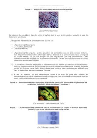 © UMVF - Université Médicale Virtuelle Francophone
Figure 15 : Microfilaire d’Onchocerca volvulus dans le derme
(Col. D.Richard-Lenoble)
La présence de microfilaires dans les urines et parfois dans le sang a été signalée, surtout à la suite de
traitements spécifiques.
Le diagnostic indirect ou de présomption est apporté par :
● L’hyperéosinophilie sanguine.
● Les réactions d’immunité.
● Le test de Mazzotti.
● L’hyperéosinophilie sanguine : un taux peu élevé est compatible avec une onchocercose évolutive,
mais fréquemment l’éosinophilie atteint 20 à 30 % à distance de la primo-invasion. Chez un migrant
de l’Ouest africain, un tel taux évoque soit une anguillulose, soit une onchocercose. Cette
hyperéosinophilie est majorée lors du traitement antifilarien. Elle est peu spécifique dans les zones
d’infections vermineuses multiples.
● Les réactions d’immunité employées au laboratoire sont les mêmes que dans les autres filarioses :
réactions de précipitation en gélose (double diffusion et analyse immunoélectrique à l’aide d’antigènes
extraits d’O. volvulus, de D. viteæ), immunoflorescence indirecte. Elles permettent plus aisément que
dans la Bancroftose une reconnaissance d’espèce.
● le test de Mazzotti, ou test thérapeutique (prurit à la suite de prise infra curative de
diéthylcarbamazine) décrit initialement dans l’onchocercose n'est plus réalisé car dangereux dans les
zones d’infections mixtes onchocercose-loase.
Figure 16 : Immunofluorescence indirecte à la recherche d’anticorps antifilariens dirigés contre les
enveloppes de la filaire adulte coupée en « rondelles »
(Col M.Gentilini , D.Richard-Lenoble EMC)
Figure 17 : Co électrosynérèse : continuité entre le sérum témoin (au centre) et le sérum du malade
(en haut) d’un arc de précipitation spécifique filarien
(Col D.Richard-Lenoble EMC)
15
 