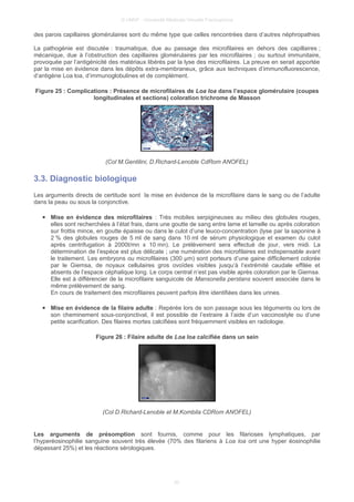 © UMVF - Université Médicale Virtuelle Francophone
des parois capillaires glomérulaires sont du même type que celles rencontrées dans d’autres néphropathies
La pathogénie est discutée : traumatique, due au passage des microfilaires en dehors des capillaires ;
mécanique, due à l’obstruction des capillaires glomérulaires par les microfilaires ; ou surtout immunitaire,
provoquée par l’antigénicité des matériaux libérés par la lyse des microfilaires. La preuve en serait apportée
par la mise en évidence dans les dépôts extra-membraneux, grâce aux techniques d’immunofluorescence,
d’antigène Loa loa, d’immunoglobulines et de complément.
Figure 25 : Complications : Présence de microfilaires de Loa loa dans l’espace glomérulaire (coupes
longitudinales et sections) coloration trichrome de Masson
(Col M.Gentilini, D.Richard-Lenoble CdRom ANOFEL)
3.3. Diagnostic biologique
Les arguments directs de certitude sont la mise en évidence de la microfilaire dans le sang ou de l’adulte
dans la peau ou sous la conjonctive.
● Mise en évidence des microfilaires : Très mobiles serpigineuses au milieu des globules rouges,
elles sont recherchées à l’état frais, dans une goutte de sang entre lame et lamelle ou après coloration
sur frottis mince, en goutte épaisse ou dans le culot d’une leuco-concentration (lyse par la saponine à
2 % des globules rouges de 5 ml de sang dans 10 ml de sérum physiologique et examen du culot
après centrifugation à 2000t/mn x 10 mn). Le prélèvement sera effectué de jour, vers midi. La
détermination de l’espèce est plus délicate ; une numération des microfilaires est indispensable avant
le traitement. Les embryons ou microfilaires (300 μm) sont porteurs d’une gaine difficilement colorée
par le Giemsa, de noyaux cellulaires gros ovoïdes visibles jusqu’à l’extrémité caudale effilée et
absents de l’espace céphalique long. Le corps central n’est pas visible après coloration par le Giemsa.
Elle est à différencier de la microfilaire sanguicole de Mansonella perstans souvent associée dans le
même prélèvement de sang.
En cours de traitement des microfilaires peuvent parfois être identifiées dans les urines.
● Mise en évidence de la filaire adulte : Repérée lors de son passage sous les téguments ou lors de
son cheminement sous-conjonctival, il est possible de l’extraire à l’aide d’un vaccinostyle ou d’une
petite scarification. Des filaires mortes calcifiées sont fréquemment visibles en radiologie.
Figure 26 : Filaire adulte de Loa loa calcifiée dans un sein
(Col D.Richard-Lenoble et M.Kombila CDRom ANOFEL)
Les arguments de présomption sont fournis, comme pour les filarioses lymphatiques, par
l’hyperéosinophilie sanguine souvent très élevée (70% des filariens à Loa loa ont une hyper éosinophilie
dépassant 25%) et les réactions sérologiques.
20
 