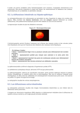 © UMVF - Université Médicale Virtuelle Francophone
Il existe une bonne corrélation entre l’échotomographie (non invasive), l’urographie intraveineuse et la
cystoscopie. Elle permet d’apprécier le degré des stases, les rétrécissements et dilatations des uretères,
l’hydronéphrose uni ou bilatérale, la calcification vésicale…
6.2. La bilharziose intestinale ou hépato-splénique
La rectosigmoïdoscopie et la colonoscopie qui permettent en plus d’apprécier le siège et le nombre des
lésions. Elles montrent des lésions ulcéreuses voire des polypes saignant facilement au contact
(bilharziome). Des prélèvements bioptiques peuvent être réalisés au cours de ces examens.
La laparoscopie visualise de plus les dilatations veineuses.
Figure 31 : Rectosigmoïdoscopie
L’échotomographie permet d’évaluer l’extension de la fibrose des espaces portes et des veinules portes
intra-hépatiques ainsi que de l’importance des dilatations des vaisseaux extra-hépatiques.
On distingue 4 stades :
• Stade 1 : épaississement léger d’une ou plusieurs veinules sans rétrécissement de la lumière
vasculaire.
• Stade 2 : épaississement pariétal plus marqué avec extension à la veine porte intra
hépatique.
• Stade 3 : épaississement important des parois de nombreuses veinules avec rétrécissement
marqué des lumières vasculaires.
• Stade 4 : épaississement des veinules entraînant une oblitération vasculaire.
La splénomanométrie confirme le diagnostic d’hypertension portale (HTP).
Le cathétérisme sushépatique bloqué, démontre l’HTP de type présinusoïdal.
La splénoportographie, obtenue par opacification vasculaire, après ponction splénique dessine le système
veineux intrasplénique, le système porte intra et extra-hépatique. Elle met en évidence l’obstacle portal
intrahépatique, le reflux dans les collatérales et le développement d’anastomoses porto-caves. Cet examen
se justifie si un geste chirurgical est envisagé.
La radiographie visualise les varices oesophagiennes.
6.3. Les bilharzioses extra-intestinales
La radiographie pulmonaire visualise des images micronodulaires disséminées ou une miliaire dans la
bilharziose cardio pulmonaire.
L’imagerie par résonnance magnétique (IRM) objective un rétrécissement médullaire dans la bilharziose du
système nerveux central ou une image pseudo tumorale cérébrale.
22
 