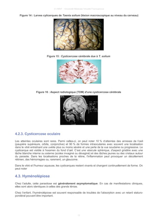 © UMVF - Université Médicale Virtuelle Francophone
Figure 14 : Larves cyticerques de Taenia solium (lésion macroscopique au niveau du cerveau)
Figure 15 : Cysticercose cérébrale due à T. solium
Figure 16 : Aspect radiologique (TDM) d'une cysticercose cérébrale
4.2.3. Cysticercose oculaire
Les atteintes oculaires sont rares. Parmi celles-ci, on peut noter 10 % d’atteintes des annexes de l’oeil
(paupière supérieure, orbite, conjonctive) et 90 % de formes intraoculaires avec souvent une localisation
dans le vitré entraînant une uvéite plus ou moins sévère et une perte de la vue soudaine ou progressive. Le
cysticerque est visible à l’examen du fond d’œil. C’est une vésicule sphérique, d'aspect grisâtre avec une
tâche blanche interne ou externe (scolex invaginé ou dévaginé) et des tâches jaunes ou des cristaux autour
du parasite. Dans les localisations proches de la rétine, l'inflammation peut provoquer un décollement
rétinien, des hémorragies ou, rarement, un glaucome.
Dans le vitré et l'humeur aqueuse, les cysticerques restent vivants et changent continuellement de forme. On
peut noter
4.3. Hyménolépiose
Chez l’adulte, cette parasitose est généralement asymptomatique. En cas de manifestations cliniques,
elles sont alors identiques à celles des grands ténias.
Chez l’enfant, l’hyménolépiose est souvent responsable de troubles de l’absorption avec un retard staturo-
pondéral pouvant être important.
12
 