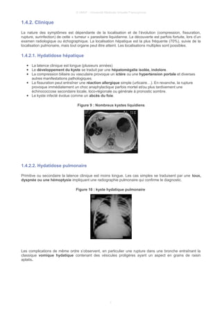 © UMVF - Université Médicale Virtuelle Francophone
1.4.2. Clinique
La nature des symptômes est dépendante de la localisation et de l’évolution (compression, fissuration,
rupture, surinfection) de cette « tumeur » parasitaire liquidienne. La découverte est parfois fortuite, lors d’un
examen radiologique ou échographique. La localisation hépatique est la plus fréquente (70%), suivie de la
localisation pulmonaire, mais tout organe peut être atteint. Les localisations multiples sont possibles.
1.4.2.1. Hydatidose hépatique
● La latence clinique est longue (plusieurs années)
● Le développement du kyste se traduit par une hépatomégalie isolée, indolore.
● La compression biliaire ou vasculaire provoque un ictère ou une hypertension portale et diverses
autres manifestations pathologiques.
● La fissuration peut entraîner une réaction allergique simple (urticaire…). En revanche, la rupture
provoque immédiatement un choc anaphylactique parfois mortel et/ou plus tardivement une
échinococcose secondaire locale, loco-régionale ou générale à pronostic sombre.
● Le kyste infecté évolue comme un abcès du foie.
Figure 9 : Nombreux kystes liquidiens
1.4.2.2. Hydatidose pulmonaire
Primitive ou secondaire la latence clinique est moins longue. Les cas simples se traduisent par une toux,
dyspnée ou une hémoptysie impliquant une radiographie pulmonaire qui confirme le diagnostic.
Figure 10 : kyste hydatique pulmonaire
Les complications de même ordre s’observent, en particulier une rupture dans une bronche entraînant la
classique vomique hydatique contenant des vésicules proligères ayant un aspect en grains de raisin
aplatis.
7
 