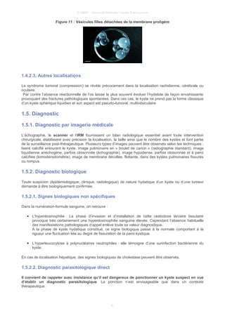 © UMVF - Université Médicale Virtuelle Francophone
Figure 11 : Vésicules filles détachées de la membrane proligère
1.4.2.3. Autres localisations
Le syndrome tumoral (compression) se révèle précocement dans la localisation rachidienne, cérébrale ou
oculaire.
Par contre l’absence réactionnelle de l’os laisse le plus souvent évoluer l’hydatide de façon envahissante
provoquant des fractures pathologiques spontanées. Dans ces cas, le kyste ne prend pas la forme classique
d’un kyste sphérique liquidien et son aspect est pseudo-tumoral, multivésiculaire.
1.5. Diagnostic
1.5.1. Diagnostic par imagerie médicale
L’échographie, le scanner et l’IRM fournissent un bilan radiologique essentiel avant toute intervention
chirurgicale, établissent avec précision la localisation, la taille ainsi que le nombre des kystes et font partie
de la surveillance post-thérapeutique. Plusieurs types d’images peuvent être observés selon les techniques :
liseré calcifié entourant le kyste, image pulmonaire en « boulet de canon » (radiographie standard), image
liquidienne anéchogène, parfois cloisonnée (échographie), image hypodense, parfois cloisonnée et à paroi
calcifiée (tomodensitométrie), image de membrane décollée, flottante, dans des kystes pulmonaires fissurés
ou rompus.
1.5.2. Diagnostic biologique
Toute suspicion (épidémiologique, clinique, radiologique) de nature hydatique d’un kyste ou d’une tumeur
demande à être biologiquement confirmée.
1.5.2.1. Signes biologiques non spécifiques
Dans la numération-formule sanguine, on retrouve :
● L’hyperéosinophilie : La phase d’invasion et d’installation de cette cestodose larvaire tissulaire
provoque très certainement une hyperéosinophilie sanguine élevée. Cependant l’absence habituelle
des manifestations pathologiques d’appel enlève toute sa valeur diagnostique.
A la phase de kyste hydatique constitué, ce signe biologique passe à la normale comportant à la
rigueur une fluctuation liée au degré de fissuration de la paroi kystique.
● L’hyperleucocytose à polynucléaires neutrophiles : elle témoigne d’une surinfection bactérienne du
kyste.
En cas de localisation hépatique, des signes biologiques de cholestase peuvent être observés.
1.5.2.2. Diagnostic parasitologique direct
Il convient de rappeler avec insistance qu’il est dangereux de ponctionner un kyste suspect en vue
d’établir un diagnostic parasitologique. La ponction n’est envisageable que dans un contexte
thérapeutique.
8
 