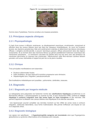 © UMVF - Université Médicale Virtuelle Francophone
Figure 19 : Le campagnol (hôte intermédiaire)
Comme dans l’hydatidose, l’homme constitue une impasse parasitaire.
2.3. Principaux aspects cliniques
2.3.1. Physiopathologie
Il s'agit d'une tumeur à diffusion racémeuse, au développement anarchique, envahissante, comprimant et
diffusant dans les canaux biliaires ainsi que dans les vaisseaux intrahépatiques. Au cours de l'invasion
larvaire, les réactions parasite-tissu hôte sont extrêmement violentes et déterminent des lésions nécrotiques
diffuses. L’antigène excrété-sécrété, à pouvoir nécrotique puissant, diffuse précocement dans des régions
avoisinantes. Ils se forment alors des manchons fibreux qui gênent partiellement l’extension anarchique des
membranes parasitaires. La membrane cuticulaire est plissée dans tous les sens avec des lambeaux de
membrane germinative et rarement des protoscolex. Ultérieurement cette fibro-nécrose s’achève laissant
persister une tumeur déshabitée à l’aspect de pain bis ou de pierre meulière.
2.3.2. Clinique
Trois principales manifestations sont observées :
● Douleurs abdominales hautes
● Ictère révélateur, de type obstructif à évolution progressive sans rémission.
● Hépatomégalie dure, irrégulière, pseudocancéreuse.
Des localisations métastatiques sont possibles : pulmonaires, cérébrales, osseuses.
2.4. Diagnostic
2.4.1. Diagnostic par imagerie médicale
La radiographie sans préparation de l’abdomen montre des calcifications hépatiques punctiformes ou en
flammèches diffuses. L’échotomographie ou scanner du foie, et plus récemment l’IRM, confirme la masse
hépatique à contours irréguliers avec des zones hyper ou hypo échogènes et des nécroses. Elle
permet d’apprécier la dilatation des canaux biliaires intra hépatiques ou la sténose vasculaire.
Une laparoscopie pourrait compléter ces données montrant ce foie infiltré de zones dures à contours
irréguliers, scléreuses blanchâtres, sous forme multinodulaire. Elle permet d’effectuer une biopsie en vue
d’un diagnostic direct.
2.4.2. Diagnostic biologique
Les signes non spécifiques : L’hyperéosinophilie sanguine est inconstante ainsi que l’hypergamma-
globulinémie Le syndrome inflammatoire et la cholestase sont marqués.
12
 