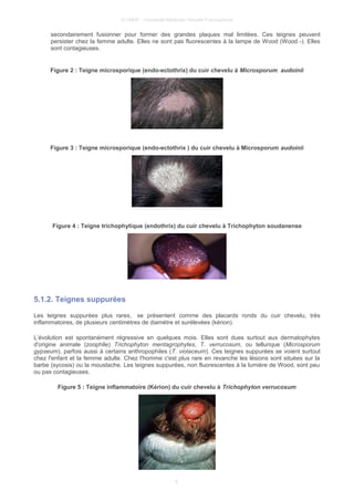 © UMVF - Université Médicale Virtuelle Francophone
secondairement fusionner pour former des grandes plaques mal limitées. Ces teignes peuvent
persister chez la femme adulte. Elles ne sont pas fluorescentes à la lampe de Wood (Wood -). Elles
sont contagieuses.
Figure 2 : Teigne microsporique (endo-ectothrix) du cuir chevelu à Microsporum audoinii
Figure 3 : Teigne microsporique (endo-ectothrix ) du cuir chevelu à Microsporum audoinii
Figure 4 : Teigne trichophytique (endothrix) du cuir chevelu à Trichophyton soudanense
5.1.2. Teignes suppurées
Les teignes suppurées plus rares, se présentent comme des placards ronds du cuir chevelu, très
inflammatoires, de plusieurs centimètres de diamètre et surélevées (kérion).
L’évolution est spontanément régressive en quelques mois. Elles sont dues surtout aux dermatophytes
d'origine animale (zoophile) Trichophyton mentagrophytes, T. verrucosum, ou tellurique (Microsporum
gypseum), parfois aussi à certains anthropophiles (T. violaceum). Ces teignes suppurées se voient surtout
chez l'enfant et la femme adulte. Chez l'homme c'est plus rare en revanche les lésions sont situées sur la
barbe (sycosis) ou la moustache. Les teignes suppurées, non fluorescentes à la lumière de Wood, sont peu
ou pas contagieuses.
Figure 5 : Teigne inflammatoire (Kérion) du cuir chevelu à Trichophyton verrucosum
6
 