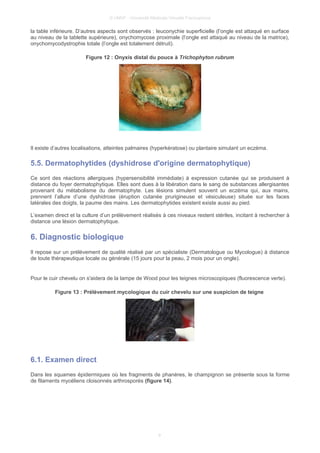 © UMVF - Université Médicale Virtuelle Francophone
la table inférieure. D’autres aspects sont observés : leuconychie superficielle (l’ongle est attaqué en surface
au niveau de la tablette supérieure), onychomycose proximale (l’ongle est attaqué au niveau de la matrice),
onychomycodystrophie totale (l’ongle est totalement détruit).
Figure 12 : Onyxis distal du pouce à Trichophyton rubrum
Il existe d’autres localisations, atteintes palmaires (hyperkératose) ou plantaire simulant un eczéma.
5.5. Dermatophytides (dyshidrose d'origine dermatophytique)
Ce sont des réactions allergiques (hypersensibilité immédiate) à expression cutanée qui se produisent à
distance du foyer dermatophytique. Elles sont dues à la libération dans le sang de substances allergisantes
provenant du métabolisme du dermatophyte. Les lésions simulent souvent un eczéma qui, aux mains,
prennent l’allure d’une dyshidrose (éruption cutanée prurigineuse et vésiculeuse) située sur les faces
latérales des doigts, la paume des mains. Les dermatophytides existent existe aussi au pied.
L’examen direct et la culture d’un prélèvement réalisés à ces niveaux restent stériles, incitant à rechercher à
distance une lésion dermatophytique.
6. Diagnostic biologique
Il repose sur un prélèvement de qualité réalisé par un spécialiste (Dermatologue ou Mycologue) à distance
de toute thérapeutique locale ou générale (15 jours pour la peau, 2 mois pour un ongle).
Pour le cuir chevelu on s'aidera de la lampe de Wood pour les teignes microscopiques (fluorescence verte).
Figure 13 : Prélèvement mycologique du cuir chevelu sur une suspicion de teigne
6.1. Examen direct
Dans les squames épidermiques où les fragments de phanères, le champignon se présente sous la forme
de filaments mycéliens cloisonnés arthrosporés (figure 14).
9
 