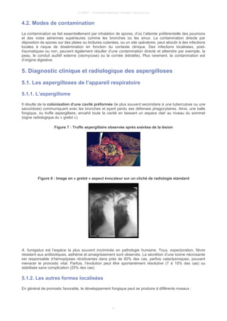 © UMVF - Université Médicale Virtuelle Francophone
4.2. Modes de contamination
La contamination se fait essentiellement par inhalation de spores, d’où l’atteinte préférentielle des poumons
et des voies aériennes supérieures comme les bronches ou les sinus. La contamination directe par
déposition de spores sur des plaies ou brûlures cutanées, ou un site opératoire, peut aboutir à des infections
locales à risque de dissémination en fonction du contexte clinique. Des infections localisées, post-
traumatiques ou non, peuvent également résulter d’une contamination directe et atteindre par exemple, la
peau, le conduit auditif externe (otomycose) ou la cornée (kératite). Plus rarement, la contamination est
d’origine digestive.
5. Diagnostic clinique et radiologique des aspergilloses
5.1. Les aspergilloses de l’appareil respiratoire
5.1.1. L’aspergillome
Il résulte de la colonisation d’une cavité préformée (le plus souvent secondaire à une tuberculose ou une
sarcoïdose) communiquant avec les bronches et ayant perdu ses défenses phagocytaires. Ainsi, une balle
fongique, ou truffe aspergillaire, envahit toute la cavité en laissant un espace clair au niveau du sommet
(signe radiologique du « grelot »).
Figure 7 : Truffe aspergillaire observée après exérèse de la lésion
Figure 8 : Image en « grelot » aspect évocateur sur un cliché de radiologie standard
A. fumigatus est l’espèce la plus souvent incriminée en pathologie humaine. Toux, expectoration, fièvre
résistant aux antibiotiques, asthénie et amaigrissement sont observés. La sécrétion d’une toxine nécrosante
est responsable d’hémoptysies récidivantes dans près de 60% des cas, parfois cataclysmiques, pouvant
menacer le pronostic vital. Parfois, l’évolution peut être spontanément résolutive (7 à 10% des cas) ou
stabilisée sans complication (25% des cas).
5.1.2. Les autres formes localisées
En général de pronostic favorable, le développement fongique peut se produire à différents niveaux :
9
 