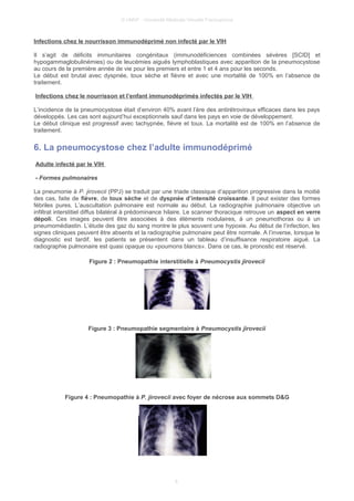 © UMVF - Université Médicale Virtuelle Francophone
Infections chez le nourrisson immunodéprimé non infecté par le VIH
Il s’agit de déficits immunitaires congénitaux (immunodéficiences combinées sévères [SCID] et
hypogammaglobulinémies) ou de leucémies aiguës lymphoblastiques avec apparition de la pneumocystose
au cours de la première année de vie pour les premiers et entre 1 et 4 ans pour les seconds.
Le début est brutal avec dyspnée, toux sèche et fièvre et avec une mortalité de 100% en l’absence de
traitement.
Infections chez le nourrisson et l’enfant immunodéprimés infectés par le VIH
L’incidence de la pneumocystose était d’environ 40% avant l’ère des antirétroviraux efficaces dans les pays
développés. Les cas sont aujourd’hui exceptionnels sauf dans les pays en voie de développement.
Le début clinique est progressif avec tachypnée, fièvre et toux. La mortalité est de 100% en l’absence de
traitement.
6. La pneumocystose chez l’adulte immunodéprimé
Adulte infecté par le VIH
- Formes pulmonaires
La pneumonie à P. jirovecii (PPJ) se traduit par une triade classique d’apparition progressive dans la moitié
des cas, faite de fièvre, de toux sèche et de dyspnée d’intensité croissante. Il peut exister des formes
fébriles pures. L’auscultation pulmonaire est normale au début. La radiographie pulmonaire objective un
infiltrat interstitiel diffus bilatéral à prédominance hilaire. Le scanner thoracique retrouve un aspect en verre
dépoli. Ces images peuvent être associées à des éléments nodulaires, à un pneumothorax ou à un
pneumomédiastin. L’étude des gaz du sang montre le plus souvent une hypoxie. Au début de l’infection, les
signes cliniques peuvent être absents et la radiographie pulmonaire peut être normale. A l’inverse, lorsque le
diagnostic est tardif, les patients se présentent dans un tableau d’insuffisance respiratoire aiguë. La
radiographie pulmonaire est quasi opaque ou «poumons blancs». Dans ce cas, le pronostic est réservé.
Figure 2 : Pneumopathie interstitielle à Pneumocystis jirovecii
Figure 3 : Pneumopathie segmentaire à Pneumocystis jirovecii
Figure 4 : Pneumopathie à P. jirovecii avec foyer de nécrose aux sommets D&G
6
 