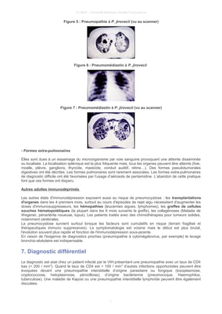 © UMVF - Université Médicale Virtuelle Francophone
Figure 5 : Pneumopathie à P. jirovecii (vu au scanner)
Figure 6 : Pneumomédiastin à P. jirovecii
Figure 7 : Pneumomédiastin à P. jirovecii (vu au scanner)
- Formes extra-pulmonaires
Elles sont dues à un essaimage du microorganisme par voie sanguine provoquant une atteinte disséminée
ou localisée. La localisation splénique est la plus fréquente mais, tous les organes peuvent être atteints (foie,
moelle, plèvre, ganglions, thyroïde, mastoïde, conduit auditif, rétine…). Des formes pseudotumorales
digestives ont été décrites. Les formes pulmonaires sont rarement associées. Les formes extra-pulmonaires
de diagnostic difficile ont été favorisées par l’usage d’aérosols de pentamidine. L’abandon de cette pratique
font que ces formes ont disparu.
Autres adultes immunodéprimés
Les autres états d'immunodépression exposent aussi au risque de pneumocystose : les transplantations
d'organes dans les 4 premiers mois, surtout au cours d'épisodes de rejet aigu nécessitant d'augmenter les
doses d'immunosuppresseurs, les hémopathies (leucémies aigues, lymphomes), les greffes de cellules
souches hématopoiétiques (la plupart dans les 6 mois suivants la greffe), les collagénoses (Maladie de
Wegener, périartérite noueuse, lupus). Les patients traités avec des chimiothérapies pour tumeurs solides,
notamment cérébrales.
La pneumocystose survient surtout lorsque les facteurs sont cumulatifs en risque (terrain fragilisé et
thérapeutiques immuno suppressives). La symptomatologie est voisine mais le début est plus brutal,
l'évolution souvent plus rapide et fonction de l'immunodépression sous-jacente.
En raison de l'exigence de diagnostics proches (pneumopathie à cytomégalovirus, par exemple) le lavage
bronchio-alvéolaire est indispensable.
7. Diagnostic différentiel
Le diagnostic est aisé chez un patient infecté par le VIH présentant une pneumopathie avec un taux de CD4
bas (< 200 / mm3
). Quand le taux de CD4 est < 100 / mm3
d’autres infections opportunistes peuvent être
évoquées devant une pneumopathie interstitielle d’origine parasitaire ou fongique (toxoplasmose,
cryptococcose, histoplasmose, pénicilliose), d’origine bactérienne (pneumocoque, Haemophilus,
tuberculose). Une maladie de Kaposi ou une pneumopathie interstitielle lymphoïde peuvent être également
discutées.
7
 
