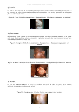 © UMVF - Université Médicale Virtuelle Francophone
1) Cutanées
Ce sont les plus fréquents. Ils prennent l’aspect de papules ou de nodules souvent ombiliqués siégeant sur
les membres, le visage (ressemblant au molluscum contagiosum). Des ulcères notamment au niveau des
plis souvent aussi observés.
Figure 8 : Peau : Histoplasmose africaine - Histoplasmose à Histoplasma capsulatum var. duboisii
2) Sous-cutanées
Ils prennent la forme d’abcès ou de masses sous-cutanées, parfois volumineuses siégeant sur le thorax
mais aussi d'adénopathies (axillaires, cervicales inguinales) pouvant être volumineuses et simuler une
adénite tuberculeuse ou un abcès froid.
Figure 9 : Ganglion : Histoplasmose africaine - Histoplasmose à Histoplasma capsulatum var.
duboisii
Figure 10 : Peau : Histoplasmose africaine - Histoplasmose à Histoplasma capsulatum var. duboisii
3) Osseuses
Ce sont des atteintes lytiques au niveau du maxillaire mais aussi du crâne, du genou, de la colonne
vertébrale simulant à ce niveau un mal de Pott.
Figure 11 : Histoplasmose africaine - lésion osseuse au niveau lombaire
10
 