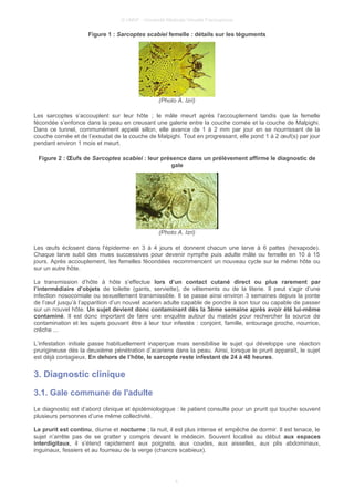 © UMVF - Université Médicale Virtuelle Francophone
Figure 1 : Sarcoptes scabiei femelle : détails sur les téguments
(Photo A. Izri)
Les sarcoptes s’accouplent sur leur hôte ; le mâle meurt après l’accouplement tandis que la femelle
fécondée s’enfonce dans la peau en creusant une galerie entre la couche cornée et la couche de Malpighi.
Dans ce tunnel, communément appelé sillon, elle avance de 1 à 2 mm par jour en se nourrissant de la
couche cornée et de l’exsudat de la couche de Malpighi. Tout en progressant, elle pond 1 à 2 œuf(s) par jour
pendant environ 1 mois et meurt.
Figure 2 : Œufs de Sarcoptes scabiei : leur présence dans un prélèvement affirme le diagnostic de
gale
(Photo A. Izri)
Les œufs éclosent dans l'épiderme en 3 à 4 jours et donnent chacun une larve à 6 pattes (hexapode).
Chaque larve subit des mues successives pour devenir nymphe puis adulte mâle ou femelle en 10 à 15
jours. Après accouplement, les femelles fécondées recommencent un nouveau cycle sur le même hôte ou
sur un autre hôte.
La transmission d’hôte à hôte s’effectue lors d’un contact cutané direct ou plus rarement par
l’intermédiaire d’objets de toilette (gants, serviette), de vêtements ou de la literie. Il peut s’agir d’une
infection nosocomiale ou sexuellement transmissible. Il se passe ainsi environ 3 semaines depuis la ponte
de l’œuf jusqu’à l’apparition d’un nouvel acarien adulte capable de pondre à son tour ou capable de passer
sur un nouvel hôte. Un sujet devient donc contaminant dès la 3ème semaine après avoir été lui-même
contaminé. Il est donc important de faire une enquête autour du malade pour rechercher la source de
contamination et les sujets pouvant être à leur tour infestés : conjoint, famille, entourage proche, nourrice,
crêche ...
L’infestation initiale passe habituellement inaperçue mais sensibilise le sujet qui développe une réaction
prurigineuse dès la deuxième pénétration d’acariens dans la peau. Ainsi, lorsque le prurit apparaît, le sujet
est déjà contagieux. En dehors de l’hôte, le sarcopte reste infestant de 24 à 48 heures.
3. Diagnostic clinique
3.1. Gale commune de l'adulte
Le diagnostic est d’abord clinique et épidémiologique : le patient consulte pour un prurit qui touche souvent
plusieurs personnes d’une même collectivité.
Le prurit est continu, diurne et nocturne ; la nuit, il est plus intense et empêche de dormir. Il est tenace, le
sujet n’arrête pas de se gratter y compris devant le médecin. Souvent localisé au début aux espaces
interdigitaux, il s’étend rapidement aux poignets, aux coudes, aux aisselles, aux plis abdominaux,
inguinaux, fessiers et au fourreau de la verge (chancre scabieux).
4
 