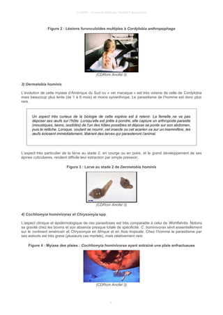 © UMVF - Université Médicale Virtuelle Francophone
Figure 2 : Lésions furonculoïdes multiples à Cordylobia anthropophaga
(CDRom Anofel 3)
3) Dermatobia hominis
L’évolution de cette myiase d’Amérique du Sud ou « ver macaque » est très voisine de celle de Cordylobia
mais beaucoup plus lente (de 1 à 6 mois) et moins synanthrope. Le parasitisme de l’homme est donc plus
rare.
Un aspect très curieux de la biologie de cette espèce est à retenir. La femelle ne va pas
déposer ses œufs sur l’hôte. Lorsqu’elle est prête à pondre, elle capture un arthropode parasite
(moustiques, taons, ixodidés) de l'un des hôtes possibles et dépose sa ponte sur son abdomen,
puis le relâche. Lorsque, voulant se nourrir, cet insecte ou cet acarien va sur un mammifère, les
œufs éclosent immédiatement, libérant des larves qui parasiteront l’animal.
L’aspect très particulier de la larve au stade 2, en courge ou en poire, et le grand développement de ses
épines cuticulaires, rendent difficile leur extraction par simple pression.
Figure 3 : Larve au stade 2 de Dermatobia hominis
(CDRom Anofel 3)
4) Cochliomyia hominivorax et Chrysomyia spp.
L’aspect clinique et épidémiologique de ces parasitoses est très comparable à celui de Wohlfahrtia. Notons
sa gravité chez les bovins et son absence presque totale de spécificité. C. hominivorax sévit essentiellement
sur le continent américain et Chrysomyia en Afrique et en Asie tropicale. Chez l’homme le parasitisme par
ses asticots est très grave (plusieurs cas mortels), mais relativement rare.
Figure 4 : Myiase des plaies : Cochliomyia hominivorax ayant entrainé une plaie anfractueuse
(CDRom Anofel 3)
8
 