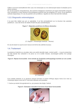 © UMVF - Université Médicale Virtuelle Francophone
Celles-ci pourront éventuellement être vues à la rectoscopie ou à la colonoscopie basse et extirpées par la
même occasion.
En cas de suspicion d’hypodermose, des examens biologiques montreront une hyper éosinophilie sanguine
et/ou rachidienne, et des réactions immunologiques positives avec les antigènes d’H. bovis, ce qui apporte la
certitude diagnostique. En cas de positivité une surveillance régulière du fond d’œil doit être instituée.
1.3.2. Diagnostic entomologique
Il ne peut être réalisé que par un spécialiste. Il se fera principalement sur la structure des spiracles
postérieurs ; ceux des larves de stades III étant les plus caractéristiques.
Figure 7 : Stigmates postérieurs de Musca domestica
(C. Guiguen - Parasitologie médicale – Rennes)
En cas de besoin on pourra avoir recours à la forme des sclérites buccaux.
1.4. Traitement
La présence d’asticots sur une plaie, dans une cavité naturelle (vagin, conduit auditif,…), sous la conjonctive
de l’œil impose leur extraction à la pince ou à la curette mousse, accompagné parfois d’un parage
chirurgical.
Figure 8 : Myiase furonculoïde : larve extraite de Cordylobia anthropophaga montrée sur une curette
mousse
(R. Pradinaud)
Si le malade présente un ou plusieurs pseudo furoncles et revient d’Afrique depuis moins d’un mois ou
d’Amérique depuis moins de 6-7 mois deux attitudes sont possibles :
1. l’active qui extrait chirurgicalement ou, par pression des doigts, l’asticot,
Figure 9 : Extraction manuelle d’une larve d’une lésion furonculoïde
(CDRom Anofel 3)
10
 