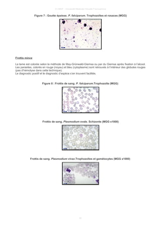 © UMVF - Université Médicale Virtuelle Francophone
Figure 7 : Goutte épaisse. P. falciparum. Trophozoïtes et rosaces (MGG)
Frottis mince
La lame est colorée selon la méthode de May-Grünwald-Giemsa ou par du Giemsa après fixation à l’alcool.
Les parasites, colorés en rouge (noyau) et bleu (cytoplasme) sont retrouvés à l’intérieur des globules rouges
(pas d’hémolyse dans cette technique).
Le diagnostic positif et le diagnostic d’espèce s’en trouvent facilités.
Figure 8 : Frottis de sang. P. falciparum.Trophozoïte (MGG)
Frottis de sang. Plasmodium ovale. Schizonte (MGG x1000)
Frottis de sang. Plasmodium vivax.Trophozoïtes et gamétocytes (MGG x1000)
20
 