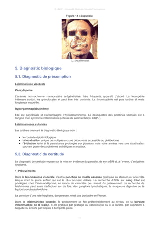 © UMVF - Université Médicale Virtuelle Francophone
Figure 14 : Espundia
(L. braziliensis)
5. Diagnostic biologique
5.1. Diagnostic de présomption
Leishmaniose viscérale
Pancytopénie
L’anémie normochrome normocytaire arégénérative, très fréquente, apparaît d’abord. La leucopénie
intéresse surtout les granulocytes et peut être très profonde. La thrombopénie est plus tardive et reste
longtemps modérée.
Hypergammaglobulinémie
Elle est polyclonale et s’accompagne d’hypoalbuminémie. Le déséquilibre des protéines sériques est à
l’origine d’un syndrome inflammatoire (vitesse de sédimentation, CRP..).
Leishmanioses cutanées
Les critères orientant le diagnostic étiologique sont :
● le contexte épidémiologique
● la localisation unique ou multiple en zone découverte accessible au phlébotome
● l’évolution lente et la persistance prolongée sur plusieurs mois voire années vers une cicatrisation
pouvant poser des problèmes esthétiques et sociaux.
5.2. Diagnostic de certitude
Le diagnostic de certitude repose sur la mise en évidence du parasite, de son ADN et, à l’avenir, d’antigènes
circulants.
1) Prélèvements
Dans la leishmaniose viscérale, c’est la ponction de moelle osseuse pratiquée au sternum ou à la crête
iliaque chez le jeune enfant qui est le plus souvent utilisée. La recherche d’ADN sur sang total est
privilégiée chez l’immunodéprimé, en raison du caractère peu invasif du prélèvement. La recherche de
leishmanies peut aussi s’effectuer sur du foie, des ganglions lymphatiques, la muqueuse digestive ou le
liquide bronchioloalvéolaire.
La ponction d’une rate fragilisée, dangereuse, n’est pas pratiquée en France.
Dans la leishmaniose cutanée, le prélèvement se fait préférentiellement au niveau de la bordure
inflammatoire de la lésion. Il est pratiqué par grattage au vaccinostyle ou à la curette, par aspiration à
l’aiguille ou encore par biopsie à l’emporte-pièce.
13
 