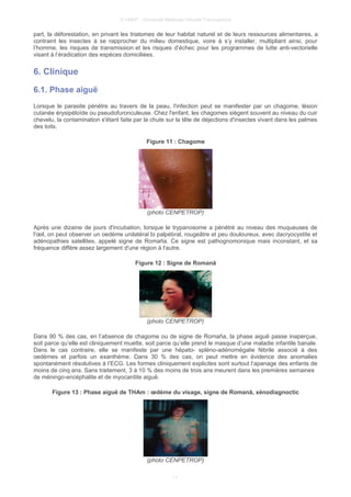 © UMVF - Université Médicale Virtuelle Francophone
part, la déforestation, en privant les triatomes de leur habitat naturel et de leurs ressources alimentaires, a
contraint les insectes à se rapprocher du milieu domestique, voire à s’y installer, multipliant ainsi, pour
l’homme, les risques de transmission et les risques d’échec pour les programmes de lutte anti-vectorielle
visant à l’éradication des espèces domiciliées.
6. Clinique
6.1. Phase aiguë
Lorsque le parasite pénètre au travers de la peau, l'infection peut se manifester par un chagome, lésion
cutanée érysipèloïde ou pseudofuronculeuse. Chez l'enfant, les chagomes siègent souvent au niveau du cuir
chevelu, la contamination s'étant faite par la chute sur la tête de déjections d'insectes vivant dans les palmes
des toits.
Figure 11 : Chagome
(photo CENPETROP)
Après une dizaine de jours d'incubation, lorsque le trypanosome a pénétré au niveau des muqueuses de
l'œil, on peut observer un oedème unilatéral bi palpébral, rougeâtre et peu douloureux, avec dacryocystite et
adénopathies satellites, appelé signe de Romaña. Ce signe est pathognomonique mais inconstant, et sa
fréquence diffère assez largement d'une région à l'autre.
Figure 12 : Signe de Romanã
(photo CENPETROP)
Dans 90 % des cas, en l’absence de chagome ou de signe de Romaña, la phase aiguë passe inaperçue,
soit parce qu’elle est cliniquement muette, soit parce qu’elle prend le masque d’une maladie infantile banale.
Dans le cas contraire, elle se manifeste par une hépato- spléno-adénomégalie fébrile associé à des
oedèmes et parfois un exanthème. Dans 30 % des cas, on peut mettre en évidence des anomalies
spontanément résolutives à l’ECG. Les formes cliniquement explicites sont surtout l’apanage des enfants de
moins de cinq ans. Sans traitement, 3 à 10 % des moins de trois ans meurent dans les premières semaines
de méningo-encéphalite et de myocardite aiguë.
Figure 13 : Phase aiguë de THAm : œdème du visage, signe de Romanã, xénodiagnoctic
(photo CENPETROP)
11
 