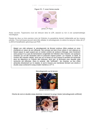 © UMVF - Université Médicale Virtuelle Francophone
Figure 15 : T. cruzi, forme courte
(photo JF Pays)
Assez souvent, Trypanosma cruzi est retrouvé dans le LCR, associé ou non à une symptomatologie
neurologique.
Passés les deux ou trois premiers mois de l'infection, la parasitémie devient indétectable par les moyens
précités. Trois techniques peuvent alors être utilisées: le xénodiagnostic, la culture du sang sur milieu de LIT
ou BHI et l'amplification génomique par PCR.
Malgré son côté artisanal, le xénodiagnostic de Brumpt continue d'être pratiqué en zone
d'endémie en raison de son efficacité. Son principe est celui d'une culture in vivo obtenue en
faisant piquer le sujet suspect par un certain nombre de vecteurs d’élevage, donc forcément
sains puisqu’il n’y a pas de transmission congénitale de l’infection chez l’insecte. Les quelques
variantes qui ont été introduites dans le protocole original portent sur l'espèce, le stade, le
nombre des insectes utilisés, ainsi que sur le temps au bout duquel le parasite est recherché
dans les déjections ou l'intestin des triatomes, ainsi que la technique avec laquelle cette
recherche est effectuée. Dans la variante dite "artificielle", les insectes, au lieu d'être
alimentés directement sur le malade, le sont à travers une membrane fermant une cloche à
double corps contenant le sang à tester maintenu à 37° C.
Xénodiagnostic sur le terrain
(photo CENPETROP)
Cloche de verre à double corps destinée à recevoir le sang à tester (xénodiagnostic artificiel)
(photo JF Pays)
14
 