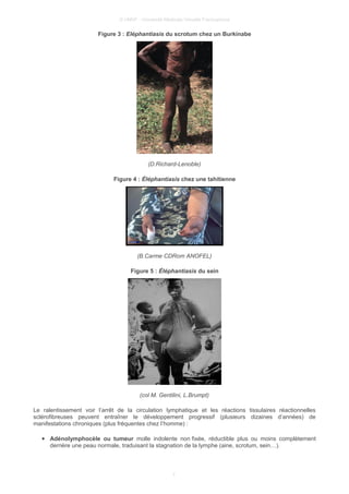 © UMVF - Université Médicale Virtuelle Francophone
Figure 3 : Eléphantiasis du scrotum chez un Burkinabe
(D.Richard-Lenoble)
Figure 4 : Éléphantiasis chez une tahitienne
(B.Carme CDRom ANOFEL)
Figure 5 : Éléphantiasis du sein
(col M. Gentilini, L.Brumpt)
Le ralentissement voir l’arrêt de la circulation lymphatique et les réactions tissulaires réactionnelles
sclérofibreuses peuvent entraîner le développement progressif (plusieurs dizaines d’années) de
manifestations chroniques (plus fréquentes chez l’homme) :
● Adénolymphocèle ou tumeur molle indolente non fixée, réductible plus ou moins complètement
derrière une peau normale, traduisant la stagnation de la lymphe (aine, scrotum, sein…).
7
 