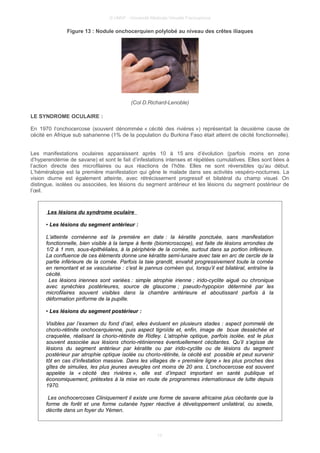 © UMVF - Université Médicale Virtuelle Francophone
Figure 13 : Nodule onchocerquien polylobé au niveau des crêtes iliaques
(Col D.Richard-Lenoble)
LE SYNDROME OCULAIRE :
En 1970 l’onchocercose (souvent dénommée « cécité des rivières ») représentait la deuxième cause de
cécité en Afrique sub saharienne (1% de la population du Burkina Faso était atteint de cécité fonctionnelle).
Les manifestations oculaires apparaissent après 10 à 15 ans d’évolution (parfois moins en zone
d’hyperendémie de savane) et sont le fait d’infestations intenses et répétées cumulatives. Elles sont liées à
l’action directe des microfilaires ou aux réactions de l’hôte. Elles ne sont réversibles qu’au début.
L’héméralopie est la première manifestation qui gêne le malade dans ses activités vespéro-nocturnes. La
vision diurne est également atteinte, avec rétrécissement progressif et bilatéral du champ visuel. On
distingue, isolées ou associées, les lésions du segment antérieur et les lésions du segment postérieur de
l’œil.
Les lésions du syndrome oculaire
• Les lésions du segment antérieur :
L’atteinte cornéenne est la première en date : la kératite ponctuée, sans manifestation
fonctionnelle, bien visible à la lampe à fente (biomicroscope), est faite de lésions arrondies de
1/2 à 1 mm, sous-épithéliales, à la périphérie de la cornée, surtout dans sa portion inférieure.
La confluence de ces éléments donne une kératite semi-lunaire avec taie en arc de cercle de la
partie inférieure de la cornée. Parfois la taie grandit, envahit progressivement toute la cornée
en remontant et se vascularise : c’est le pannus cornéen qui, lorsqu’il est bilatéral, entraîne la
cécité.
Les lésions iriennes sont variées : simple atrophie irienne ; irido-cyclite aiguë ou chronique
avec synéchies postérieures, source de glaucome ; pseudo-hypopion déterminé par les
microfilaires souvent visibles dans la chambre antérieure et aboutissant parfois à la
déformation piriforme de la pupille.
• Les lésions du segment postérieur :
Visibles par l’examen du fond d’œil, elles évoluent en plusieurs stades : aspect pommelé de
chorio-rétinite onchocerquienne, puis aspect tigroïde et, enfin, image de boue desséchée et
craquelée, réalisant la chorio-rétinite de Ridley. L’atrophie optique, parfois isolée, est le plus
souvent associée aux lésions chorio-rétiniennes éventuellement cécitantes. Qu’il s’agisse de
lésions du segment antérieur par kératite ou par irido-cyclite ou de lésions du segment
postérieur par atrophie optique isolée ou chorio-rétinite, la cécité est possible et peut survenir
tôt en cas d’infestation massive. Dans les villages de « première ligne » les plus proches des
gîtes de simulies, les plus jeunes aveugles ont moins de 20 ans. L’onchocercose est souvent
appelée la « cécité des rivières », elle est d’impact important en santé publique et
économiquement, prétextes à la mise en route de programmes internationaux de lutte depuis
1970.
Les onchocercoses Cliniquement il existe une forme de savane africaine plus cécitante que la
forme de forêt et une forme cutanée hyper réactive à développement unilatéral, ou sowda,
décrite dans un foyer du Yémen.
13
 