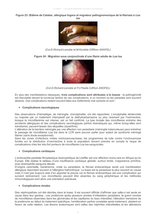 © UMVF - Université Médicale Virtuelle Francophone
Figure 23: Œdème de Calabar, allergique fugace et migrateur pathognomonique de la filariose à Loa
loa
(Col D.Richard-Lenoble et M.Kombila CRRom ANOFEL)
Figure 24 : Migration sous conjonctivale d’une filaire adulte de Loa loa
(Col D.Richard-Lenoble et PJ.Pisella CdRom ANOFEL)
En plus des manifestations classiques, trois complications sont attribuées à la loaose : la pathogénicité
est discutable devant la survenue tardive de ces complications, à un moment où les parasites sont souvent
absents. Ces complications restent souvent liées aux traitements mal conduits et sont :
● Complications neurologiques
Des observations d’hémiplégie, de méningite, d’encéphalite, ont été rapportées. L’encéphalite déclenchée
ou majorée par un traitement intempestif par la diéthylcarbamazine ou plus rarement par l’ivermectine,
lorsque la microfilarémie est intense, est un fait confirmé. La lyse brutale des microfilaires entraîne des
accidents allergiques et des complications neurologiques parfois dramatiques qui, même lorsqu’elles sont
transitoires, peuvent laisser des séquelles (dysarthrie).
L’altération de la barrière méningée par une affection non parasitaire (méningite tuberculeuse) peut entraîner
le passage de microfilaires Loa loa dans le LCR sans pouvoir parler pour autant de syndrome méningé
filarien (sans doute exceptionnel).
Dans les zones d’infections mixtes onchocercose-loase, les programmes de lutte contre l’onchocercose
fondés sur la distribution d’ivermectine à toute la population doivent prendre en compte le risque de
complications chez les très fort porteurs de microfilaires Loa loa sanguicoles.
● Complications cardiaques
L’endocardite pariétale fibroplastique éosinophilique de Löeffler est une affection moins rare en Afrique qu’en
Europe. Elle réalise le tableau d’une insuffisance cardiaque globale, surtout droite, d’apparence primitive,
avec éosinophilie sanguine élevée.
D’origine carentielle, bactérienne, virale ou parasitaire, la fibrose endocardique serait une manifestation
allergique répondant souvent à l’allergène helminthique. La loase est la parasitose la plus souvent en cause
mais il n’est pas toujours aisé d’en apporter la preuve car la fibrose endocardique est une complication qui
survient tardivement. Les microfilaires peuvent être absentes du sang périphérique et les méthodes
immunologiques sont alors une orientation précieuse.
● Complications rénales
Des néphropathies ont été décrites dans la loase. Il est souvent difficile d’affirmer que celle-ci est seule en
cause dans leur genèse ; une protéinurie après plusieurs années d’infestation parasitaire, le grand nombre
de microfilaires observées dans les glomérules et les capillaires du tissu interstitiel, l’élévation transitoire de
la protéinurie au début du traitement spécifique, l’amélioration parfois constatée après traitement, plaident en
faveur de cette relation. Les lésions anatomiques sont celles des néphrites interstitielles et les altérations
19
 