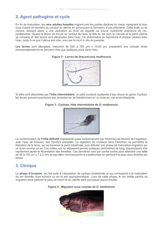 © UMVF - Université Médicale Virtuelle Francophone
2. Agent pathogène et cycle
En fin de maturation, les vers adultes femelles migrent vers les parties déclives du corps, rejoignent le tissu
sous-cutané et viennent au contact du derme en provoquant la formation d’une phlyctène. Cette bulle va se
rompre, laissant place à une ulcération au fond de laquelle se trouve l’extrémité antérieure du ver,
opalescente. Quand la lésion se trouve au contact de l’eau, la tête du ver sort, la cuticule et la paroi utérine
se rompent, et des larves sont déversées dans l’eau. Ce phénomène se reproduira à chaque contact avec
l’eau, jusqu’à ce que l’utérus soit vide, suivi par la mort in situ du parasite.
Les larves sont allongées, mesurent de 500 à 750 µm x 15-20 µm, possèdent une cuticule striée
transversalement et ne peuvent vivre que quelques jours dans l’eau.
Figure 2 : Larves de Dracunculus medinensis
Si elles sont absorbées par l’hôte intermédiaire, un petit crustacé copépode d’eau douce du genre Cyclops,
les larves peuvent poursuivre leur évolution en se transformant en un mois en une larve infestante.
Figure 3 : Cyclops, hôte intermédiaire de D. medinensis
La contamination de l’hôte définitif (représenté quasi exclusivement par l’Homme) se fait lors de l’ingestion,
avec l’eau de boisson, des Cyclops parasités. La digestion du crustacé dans l’estomac va permettre la
libération de la larve, qui va traverser la paroi intestinale, puis débuter une phase de maturation-migration qui
va durer environ un an. Les mâles, qui ne dépassent jamais quelques centimètres de long, disparaissent très
rapidement après la fécondation des femelles. Ces dernières vont par contre croître pour atteindre une taille
de 50 à 100 cm x 1 à 2 mm lorsqu’elles commenceront à s’extérioriser en perforant la peau pour émettre les
larves.
3. Clinique
La phase d’invasion, qui fait suite à l’absorption de cyclops contaminés et qui correspond à la maturation
du ver femelle, dure environ un an et est asymptomatique. Lors de cette phase, le ver arrête parfois sa
migration sans perforer la peau et meurt et se calcifie sans provoquer aucun trouble.
Figure 4 : Migration sous cutanée de D. medinensis
4
 