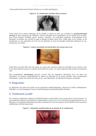 © UMVF - Université Médicale Virtuelle Francophone
Il sera parfois découvert de façon fortuite sur un cliché radiologique.
Figure 5 : D. medinensis calcifiée dans le bassin
C’est l’issue de la partie antérieure de la femelle a travers la peau qui constitue la symptomatologie
clinique la plus marquante de l’affection. Parfois précédée de la visualisation du ver adulte sous la peau,
puis d’une réaction localisée (prurit, douleur, urticaire), une phlyctène apparaît, accompagnée d’une
sensation de brûlure qui conduit le sujet à plonger la lésion dans l’eau. Cette bulle va se rompre, et se
transformer en une ulcération de 5-10 mm de diamètre au fond de laquelle l’extrémité antérieure du ver,
translucide, est visible.
Figure 6 : Lésion succédant à la perforation de la peau par le ver
Cette lésion est dans 90% des cas située au niveau des membres inférieurs (cheville) ou du scrotum, mais
le ver peut perforer la peau à n’importe quel endroit du corps. Un même sujet peut être porteur de plusieurs
vers.
Des complications mécaniques peuvent survenir lors de migrations aberrantes d’un ver dans une
articulation, le scrotum, éventuellement la plèvre, le péricarde ou le canal rachidien. Des complications
infectieuses à partir de l’orifice de sortie du ver, sont fréquentes. Un tétanos est toujours à redouter.
4. Diagnostic
Le diagnostic est avant tout basé sur les arguments épidémiologiques, cliniques et parfois radiologiques,
l’affection ne s’accompagnant d’aucun trouble biologique (hyperéosinophilie discrète).
5. Traitement curatif
De nombreux traitements médicaux anthelminthiques ont été testés sans succès dans la dracunculose. Le
seul traitement efficace est l’extraction traditionnelle et douce du ver en l’enroulant progressivement sur un
bâtonnet. Un traitement antibiotique peut être nécessaire en cas de suspicion de surinfection et la couverture
antitétanique doit être rigoureuse.
Figure 7 : Extraction traditionnelle de la femelle de D. medinensis
5
 