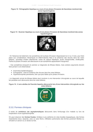 © UMVF - Université Médicale Virtuelle Francophone
Figure 12 : Échographie hépatique au cours d’une phase d’invasion de fasciolose montrant des
zones hypoéchogènes
Figure 13 : Scanner hépatique au cours d’une phase d’invasion de fasciolose montrant des zones
hypoéchogènes
- En l'absence de traitement, les symptômes de la phase d'invasion disparaissent en 2 ou 3 mois, pour faire
place aux complications mécaniques et inflammatoires liées à la présence des douves dans les voies
biliaires : poussées d'ictère rétentionnel, crises de colique hépatique, accès d'angiocholite, cholécystite.
Parfois la phase d'invasion est silencieuse et ces symptômes apparaissent inauguraux.
- Ces symptômes évoquent en premier un diagnostic de lithiase biliaire, mais certains arguments doivent
faire penser à une distomatose :
● Anamnèse épidémiologique,
● Echographie : mise en évidence des douves dans les voies biliaires,
● Hyperéosinophilie persistante, bien que plus faible qu'en phase d'invasion.
- Le diagnostic erroné de lithiase biliaire peut conduire à une intervention chirurgicale au cours de laquelle
les parasites sont découverts dans les voies biliaires.
Figure 14 : 4 vers adultes de Fasciola hepatica découverts lors d'une intervention chirurgicale sur les
voies biliaires
2.3.2. Formes cliniques
Il existe de nombreux cas asymptomatiques découverts dans l'entourage d'un malade ou lors de
l'exploration d'une hyperéosinophilie.
On peut observer des formes frustes, limitées à une asthénie et à des troubles dyspeptiques, des formes
respiratoires (toux, dyspnée, avec ou sans fièvre, infiltration pulmonaire) des formes purement fébriles ou
simulant un cancer ou un abcès du foie.
9
 