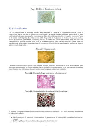 © UMVF - Université Médicale Virtuelle Francophone
Figure 20 : Œuf de Schistosoma mekongi
5.2.1.3. Les biopsies
Les biopsies rectales et vésicales peuvent être réalisées au cours de la rectosigmoïdoscopie ou de la
cystoscopie. Même en cas de bilharziose uro-génitale, la biopsie rectale est aussi performante et donc
préférable à la biopsie vésicale plus traumatisante. Elles doivent être pratiquées lorsque les examens d’urine
et de selles sont négatifs. On prélève des petits fragments de muqueuse et de sous-muqueuse, soit au
niveau d’une lésion (granulome, ulcération), soit sur le bord d’une valvule de Houston, sans les fixer. Les
fragments sont ensuite écrasés entre lame et lamelle et montés dans de la gomme au chloral pour son
grand pouvoir éclaircissant, puis examinés au microscope. C’est la forme des œufs et la position de l’éperon
qui donnera le diagnostic.
Figure 21 : Biopsie rectale
L’examen anatomo-pathologique d’une biopsie rectale, vésicale, hépatique ou d’un autre organe peut
retrouver des œufs plus ou moins calcifiés avec une réaction granulomateuse et de nombreux éosinophiles.
L’identification sur colorations standard anatomopathologiques est parfois malaisée.
Figure 22 : Histopathologie : granulome bilharzien rectal
Figure 23 : Histopathologie : granulome bilharzien vésical
Si l’éperon n’est pas visible en fonction de l’incidence de coupe de l’œuf, il faut avoir recours à la technique
de coloration de Ziehl :
● Ziehl positif pour S. mansoni, S. intercalatum, S. japonicum et S. mekongi (coque de l’œuf colorée en
rouge)
● Ziehl négatif pour S. haematobium (coque de l’œuf non colorée).
19
 