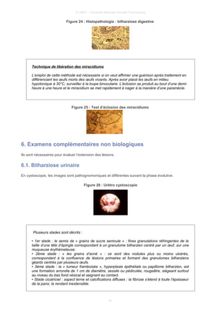 © UMVF - Université Médicale Virtuelle Francophone
Figure 24 : Histopathologie : bilharziose digestive
Technique de libération des miracidiums
L’emploi de cette méthode est nécessaire si on veut affirmer une guérison après traitement en
différenciant les œufs morts des œufs vivants. Après avoir placé les œufs en milieu
hypotonique à 30°C, surveiller à la loupe binoculaire. L’éclosion se produit au bout d’une demi-
heure à une heure et le miracidium se met rapidement à nager à la manière d’une paramécie.
Figure 25 : Test d’éclosion des miracidiums
6. Examens complémentaires non biologiques
Ils sont nécessaires pour évaluer l’extension des lésions.
6.1. Bilharziose urinaire
En cystoscopie, les images sont pathognomoniques et différentes suivant la phase évolutive.
Figure 26 : Urétro cystoscopie
Plusieurs stades sont décrits :
• 1er stade : le semis de « grains de sucre semoule » : fines granulations réfringentes de la
taille d’une tête d’épingle correspondant à un granulome bilharzien centré par un œuf, sur une
muqueuse érythémateuse.
• 2ème stade : « les grains d’acné » : ce sont des nodules plus ou moins ulcérés,
correspondant à la confluence de lésions primaires et formant des granulomes bilharziens
géants centrés par plusieurs œufs.
• 3ème stade : la « tumeur framboisée », hyperplasie épithéliale ou papillome bilharzien, est
une formation arrondie de 1 cm de diamètre, sessile ou pédiculée, rougeâtre, siègeant surtout
au niveau du bas fond vésical et saignant au contact.
• Stade cicatriciel : aspect terne et calcifications diffuses : la fibrose s’étend à toute l’épaisseur
de la paroi, la rendant inextensible.
20
 