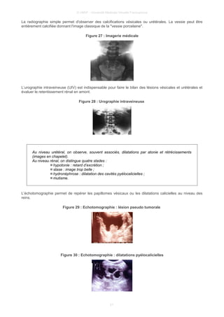 © UMVF - Université Médicale Virtuelle Francophone
La radiographie simple permet d'observer des calcifications vésicales ou urétérales. La vessie peut être
entièrement calcifiée donnant l'image classique de la "vessie porcelaine".
Figure 27 : Imagerie médicale
L’urographie intraveineuse (UIV) est indispensable pour faire le bilan des lésions vésicales et urétérales et
évaluer le retentissement rénal en amont.
Figure 28 : Urographie intraveineuse
Au niveau urétéral, on observe, souvent associés, dilatations par atonie et rétrécissements
(images en chapelet).
Au niveau rénal, on distingue quatre stades :
¤ hypotonie : retard d’excrétion ;
¤ stase : image trop belle ;
¤ hydronéphrose : dilatation des cavités pyélocalicielles ;
¤ mutisme.
L’échotomographie permet de repérer les papillomes vésicaux ou les dilatations calicielles au niveau des
reins.
Figure 29 : Echotomographie : lésion pseudo tumorale
Figure 30 : Echotomographie : dilatations pyélocalicielles
21
 