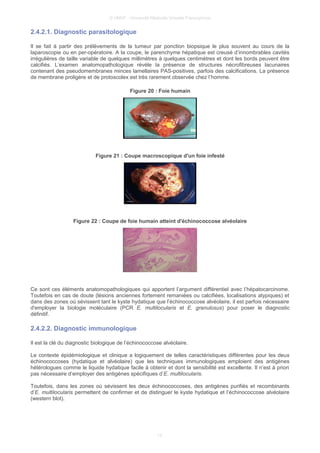 © UMVF - Université Médicale Virtuelle Francophone
2.4.2.1. Diagnostic parasitologique
Il se fait à partir des prélèvements de la tumeur par ponction biopsique le plus souvent au cours de la
laparoscopie ou en per-opératoire. A la coupe, le parenchyme hépatique est creusé d’innombrables cavités
irrégulières de taille variable de quelques millimètres à quelques centimètres et dont les bords peuvent être
calcifiés. L’examen anatomopathologique révèle la présence de structures nécrofibreuses lacunaires
contenant des pseudomembranes minces lamellaires PAS-positives, parfois des calcifications. La présence
de membrane proligère et de protoscolex est très rarement observée chez l’homme.
Figure 20 : Foie humain
Figure 21 : Coupe macroscopique d'un foie infesté
Figure 22 : Coupe de foie humain atteint d'échinococcose alvéolaire
Ce sont ces éléments anatomopathologiques qui apportent l’argument différentiel avec l’hépatocarcinome.
Toutefois en cas de doute (lésions anciennes fortement remaniées ou calcifiées, localisations atypiques) et
dans des zones où sévissent tant le kyste hydatique que l’échinococcose alvéolaire, il est parfois nécessaire
d'employer la biologie moléculaire (PCR E. multilocularis et E. granulosus) pour poser le diagnostic
définitif.
2.4.2.2. Diagnostic immunologique
Il est la clé du diagnostic biologique de l’échinococcose alvéolaire.
Le contexte épidémiologique et clinique a logiquement de telles caractéristiques différentes pour les deux
échinococcoses (hydatique et alvéolaire) que les techniques immunologiques emploient des antigènes
hétérologues comme le liquide hydatique facile à obtenir et dont la sensibilité est excellente. Il n’est à priori
pas nécessaire d’employer des antigènes spécifiques d’E. multilocularis.
Toutefois, dans les zones où sévissent les deux échinococcoses, des antigènes purifiés et recombinants
d’E. multilocularis permettent de confirmer et de distinguer le kyste hydatique et l’échinococcose alvéolaire
(western blot).
13
 
