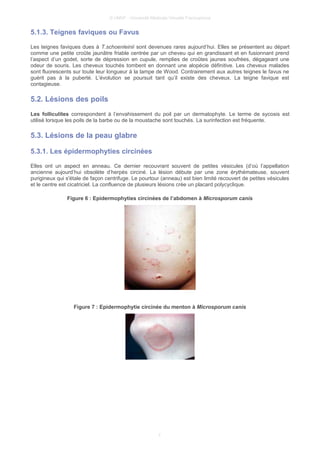 © UMVF - Université Médicale Virtuelle Francophone
5.1.3. Teignes faviques ou Favus
Les teignes faviques dues à T.schoenleinii sont devenues rares aujourd’hui. Elles se présentent au départ
comme une petite croûte jaunâtre friable centrée par un cheveu qui en grandissant et en fusionnant prend
l’aspect d’un godet, sorte de dépression en cupule, remplies de croûtes jaunes soufrées, dégageant une
odeur de souris. Les cheveux touchés tombent en donnant une alopécie définitive. Les cheveux malades
sont fluorescents sur toute leur longueur à la lampe de Wood. Contrairement aux autres teignes le favus ne
guérit pas à la puberté. L’évolution se poursuit tant qu’il existe des cheveux. La teigne favique est
contagieuse.
5.2. Lésions des poils
Les folliculites correspondent à l’envahissement du poil par un dermatophyte. Le terme de sycosis est
utilisé lorsque les poils de la barbe ou de la moustache sont touchés. La surinfection est fréquente.
5.3. Lésions de la peau glabre
5.3.1. Les épidermophyties circinées
Elles ont un aspect en anneau. Ce dernier recouvrant souvent de petites vésicules (d’où l’appellation
ancienne aujourd’hui obsolète d’herpès circiné. La lésion débute par une zone érythémateuse, souvent
purigineux qui s'étale de façon centrifuge. Le pourtour (anneau) est bien limité recouvert de petites vésicules
et le centre est cicatriciel. La confluence de plusieurs lésions crée un placard polycyclique.
Figure 6 : Epidermophyties circinées de l’abdomen à Microsporum canis
Figure 7 : Epidermophytie circinée du menton à Microsporum canis
7
 