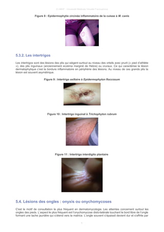 © UMVF - Université Médicale Virtuelle Francophone
Figure 8 : Epidermophytie circinée inflammatoire de la cuisse à M. canis
5.3.2. Les intertrigos
Les intertrigos sont des lésions des plis qui siègent surtout au niveau des orteils avec prurit (« pied d’athlète
»), des plis inguinaux (anciennement eczéma marginé de Hebra) ou cruraux. Ce qui caractérise la lésion
dermatophytique c’est la bordure inflammatoire en périphérie des lésions. Au niveau de ces grands plis la
lésion est souvent asymétrique.
Figure 9 : Intertrigo axillaire à Epidermophyton floccosum
Figure 10 : Intertrigo inguinal à Trichophyton rubrum
Figure 11 : Intertrigo interdigito plantaire
5.4. Lésions des ongles : onyxis ou onychomycoses
C'est le motif de consultation le plus fréquent en dermatomycologie. Les atteintes concernent surtout les
ongles des pieds. L’aspect le plus fréquent est l’onychomycose disto-latérale touchant le bord libre de l’ongle
formant une tache jaunâtre qui s’étend vers la matrice. L’ongle souvent s’épaissit devient dur et s’effrite par
8
 