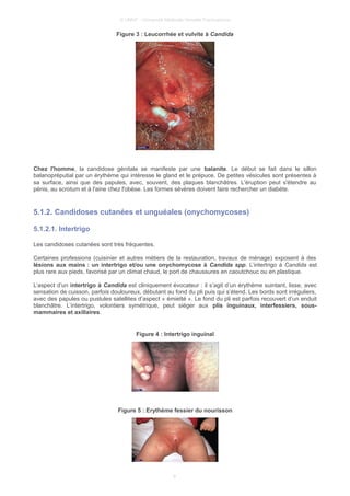 © UMVF - Université Médicale Virtuelle Francophone
Figure 3 : Leucorrhée et vulvite à Candida
Chez l'homme, la candidose génitale se manifeste par une balanite. Le début se fait dans le sillon
balanopréputial par un érythème qui intéresse le gland et le prépuce. De petites vésicules sont présentes à
sa surface, ainsi que des papules, avec, souvent, des plaques blanchâtres. L'éruption peut s'étendre au
pénis, au scrotum et à l'aine chez l'obèse. Les formes sévères doivent faire rechercher un diabète.
5.1.2. Candidoses cutanées et unguéales (onychomycoses)
5.1.2.1. Intertrigo
Les candidoses cutanées sont très fréquentes.
Certaines professions (cuisinier et autres métiers de la restauration, travaux de ménage) exposent à des
lésions aux mains : un intertrigo et/ou une onychomycose à Candida spp. L’intertrigo à Candida est
plus rare aux pieds, favorisé par un climat chaud, le port de chaussures en caoutchouc ou en plastique.
L’aspect d’un intertrigo à Candida est cliniquement évocateur : il s’agit d’un érythème suintant, lisse, avec
sensation de cuisson, parfois douloureux, débutant au fond du pli puis qui s’étend. Les bords sont irréguliers,
avec des papules ou pustules satellites d’aspect « émietté ». Le fond du pli est parfois recouvert d’un enduit
blanchâtre. L’intertrigo, volontiers symétrique, peut siéger aux plis inguinaux, interfessiers, sous-
mammaires et axillaires.
Figure 4 : Intertrigo inguinal
Figure 5 : Erythéme fessier du nourisson
9
 