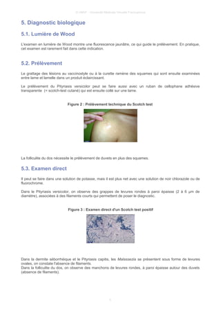 © UMVF - Université Médicale Virtuelle Francophone
5. Diagnostic biologique
5.1. Lumière de Wood
L'examen en lumière de Wood montre une fluorescence jaunâtre, ce qui guide le prélèvement. En pratique,
cet examen est rarement fait dans cette indication.
5.2. Prélèvement
Le grattage des lésions au vaccinostyle ou à la curette ramène des squames qui sont ensuite examinées
entre lame et lamelle dans un produit éclaircissant.
Le prélèvement du Pityriasis versicolor peut se faire aussi avec un ruban de cellophane adhésive
transparente (= scotch-test cutané) qui est ensuite collé sur une lame.
Figure 2 : Prélèvement technique du Scotch test
La folliculite du dos nécessite le prélèvement de duvets en plus des squames.
5.3. Examen direct
Il peut se faire dans une solution de potasse, mais il est plus net avec une solution de noir chlorazole ou de
fluorochrome.
Dans le Pityriasis versicolor, on observe des grappes de levures rondes à paroi épaisse (2 à 6 µm de
diamètre), associées à des filaments courts qui permettent de poser le diagnostic.
Figure 3 : Examen direct d'un Scotch test positif
Dans la dermite séborrhéique et le Pityriasis capitis, les Malassezia se présentent sous forme de levures
ovales, on constate l'absence de filaments.
Dans la folliculite du dos, on observe des manchons de levures rondes, à paroi épaisse autour des duvets
(absence de filaments).
5
 