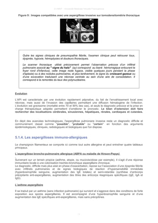 © UMVF - Université Médicale Virtuelle Francophone
Figure 9 : Images compatibles avec une aspergillose invasive sur tomodensitométrie thoracique
Outre les signes cliniques de pneumopathie fébrile, l’examen clinique peut retrouver toux,
dyspnée, hypoxie, hémoptysies et douleurs thoraciques.
Le scanner thoracique utilisé précocement permet l’observation précoce d’un infiltrat
pulmonaire associé au " signe du halo" (qui correspond au liseré hémorragique entourant le
foyer rond d'infarctus), cette image reste fugace, visible quelques jours pendant la phase
d'aplasie) ou à des nodules pulmonaires, et plus tardivement, le signe du croissant gazeux ou
d’une excavation traduisant une nécrose centrale au sein d’une aire de consolidation. Il
correspond à la remontée du taux des polynucléaires.
Evolution
L’API est caractérisée par une évolution rapidement péjorative, du fait de l’envahissement local avec
nécrose, mais aussi de l’invasion des capillaires permettant une diffusion hématogène de l’infection.
L’évolution est gravissime (mortalité entre 70 et 90% des cas), et seuls le diagnostic précoce et la prise en
charge thérapeutique adaptée permettent d’améliorer le pronostic. Le bilan d’extension doit faire
rechercher des localisations cérébrales, sinusiennes, hépatiques, rénales, cardiaques et cutanées.
En dépit des avancées technologiques, l'aspergillose pulmonaire invasive reste un diagnostic difficile et
communément classé comme "possible", "probable" ou "certain" en fonction des arguments
épidémiologiques, cliniques, radiologiques et biologiques que l'on dispose.
5.1.4. Les aspergilloses immuno-allergiques
Le champignon filamenteux se comporte ici comme tout autre allergène et peut entraîner quatre tableaux
principaux.
L’aspergillose broncho-pulmonaire allergique (ABPA ou maladie de Hinson-Pepys)
Survenant sur un terrain propice (asthme, atopie, ou mucoviscidose par exemple), il s’agit d’une réponse
immunitaire locale à une colonisation trachéo-bronchique aspergillaire chronique.
Le diagnostic, difficile mais plus aisé en phase d’exacerbation, repose sur l’association d’une dyspnée fébrile
avec infiltrats pulmonaires et de signes biologiques de réaction d’hypersensibilité immédiate
(hyperéosinophilie sanguine, augmentation des IgE totales) et semi-retardée (synthèse d’anticorps
précipitants anti-aspergillaires, augmentation des titres des anticorps réaginiques spécifiques (IgE, IgA et
IgG).
L’asthme aspergillaire
Il se traduit par un asthme (sans infection pulmonaire) qui survient et s’aggrave dans des conditions de forte
exposition aux spores aspergillaires. Il est accompagné d’une hyperéosinophilie sanguine et d’une
augmentation des IgE spécifiques anti-aspergillaires, mais sans précipitines.
11
 