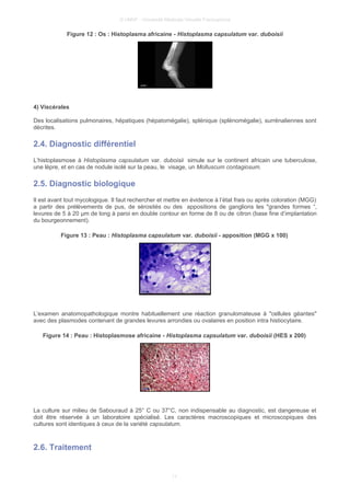 © UMVF - Université Médicale Virtuelle Francophone
Figure 12 : Os : Histoplasma africaine - Histoplasma capsulatum var. duboisii
4) Viscérales
Des localisations pulmonaires, hépatiques (hépatomégalie), splénique (splénomégalie), surrénaliennes sont
décrites.
2.4. Diagnostic différentiel
L’histoplasmose à Histoplasma capsulatum var. duboisii simule sur le continent africain une tuberculose,
une lèpre, et en cas de nodule isolé sur la peau, le visage, un Molluscum contagiosum.
2.5. Diagnostic biologique
Il est avant tout mycologique. Il faut rechercher et mettre en évidence à l’état frais ou après coloration (MGG)
a partir des prélèvements de pus, de sérosités ou des appositions de ganglions les "grandes formes “,
levures de 5 à 20 µm de long à paroi en double contour en forme de 8 ou de citron (base fine d’implantation
du bourgeonnement).
Figure 13 : Peau : Histoplasma capsulatum var. duboisii - apposition (MGG x 100)
L’examen anatomopathologique montre habituellement une réaction granulomateuse à "cellules géantes"
avec des plasmodes contenant de grandes levures arrondies ou ovalaires en position intra histiocytaire.
Figure 14 : Peau : Histoplasmose africaine - Histoplasma capsulatum var. duboisii (HES x 200)
La culture sur milieu de Sabouraud à 25° C ou 37°C, non indispensable au diagnostic, est dangereuse et
doit être réservée à un laboratoire spécialisé. Les caractères macroscopiques et microscopiques des
cultures sont identiques à ceux de la variété capsulatum.
2.6. Traitement
11
 