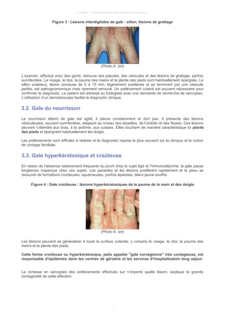 © UMVF - Université Médicale Virtuelle Francophone
Figure 3 : Lésions interdigitales de gale : sillon, lésions de grattage
(Photo A. Izri)
L’examen, effectué avec des gants, retrouve des papules, des vésicules et des lésions de grattage, parfois
surinfectées. Le visage, le dos, la paume des mains et la plante des pieds sont habituellement épargnés. Le
sillon scabieux, lésion sinueuse de 5 à 15 mm, légèrement surélevée et se terminant par une vésicule
perlée, est pathognomonique mais rarement retrouvé. Un prélèvement cutané est souvent nécessaire pour
confirmer le diagnostic. Le patient est adressé au biologiste avec une demande de recherche de sarcoptes.
L’utilisation d’un dermatoscope facilite le diagnostic clinique.
3.2. Gale du nourrisson
Le nourrisson atteint de gale est agité, il pleure constamment et dort peu. Il présente des lésions
vésiculeuses, souvent surinfectées, siégeant au niveau des aisselles, de l’ombilic et des fesses. Ces lésions
peuvent s’étendre aux bras, à la poitrine, aux cuisses. Elles touchent de manière caractéristique la plante
des pieds et épargnent habituellement les doigts.
Les prélèvements sont difficiles à réaliser et le diagnostic repose le plus souvent sur la clinique et la notion
de contage familiale.
3.3. Gale hyperkératosique et croûteuse
En raison de l’absence relativement fréquente du prurit chez le sujet âgé et l’immunodéprimé, la gale passe
longtemps inaperçue chez ces sujets. Les parasites et les lésions prolifèrent rapidement et la peau se
recouvre de formations croûteuses, squameuses, parfois épaisses, blanc-jaune souffre.
Figure 4 : Gale croûteuse : lésions hyperkératosiques de la paume de la main et des doigts
(Photo A. Izri)
Les lésions peuvent se généraliser à toute la surface cutanée, y compris le visage, le dos, la paume des
mains et la plante des pieds.
Cette forme croûteuse ou hyperkératosique, jadis appelée "gale norvégienne" très contagieuse, est
responsable d’épidémies dans les centres de gériatrie et les services d’hospitalisation long séjour.
La richesse en sarcoptes des prélèvements effectués sur n’importe quelle lésion, explique la grande
contagiosité de cette affection.
5
 
