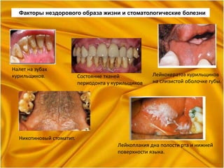 Факторы нездорового образа жизни и стоматологические болезни
Лейкоплакия дна полости рта и нижней
поверхности языка.
Никотиновый стоматит.
Лейкокератоз курильщиков
на слизистой оболочке губы.
Состояние тканей
периодонта у курильщиков
Налет на зубах
курильщиков.
 